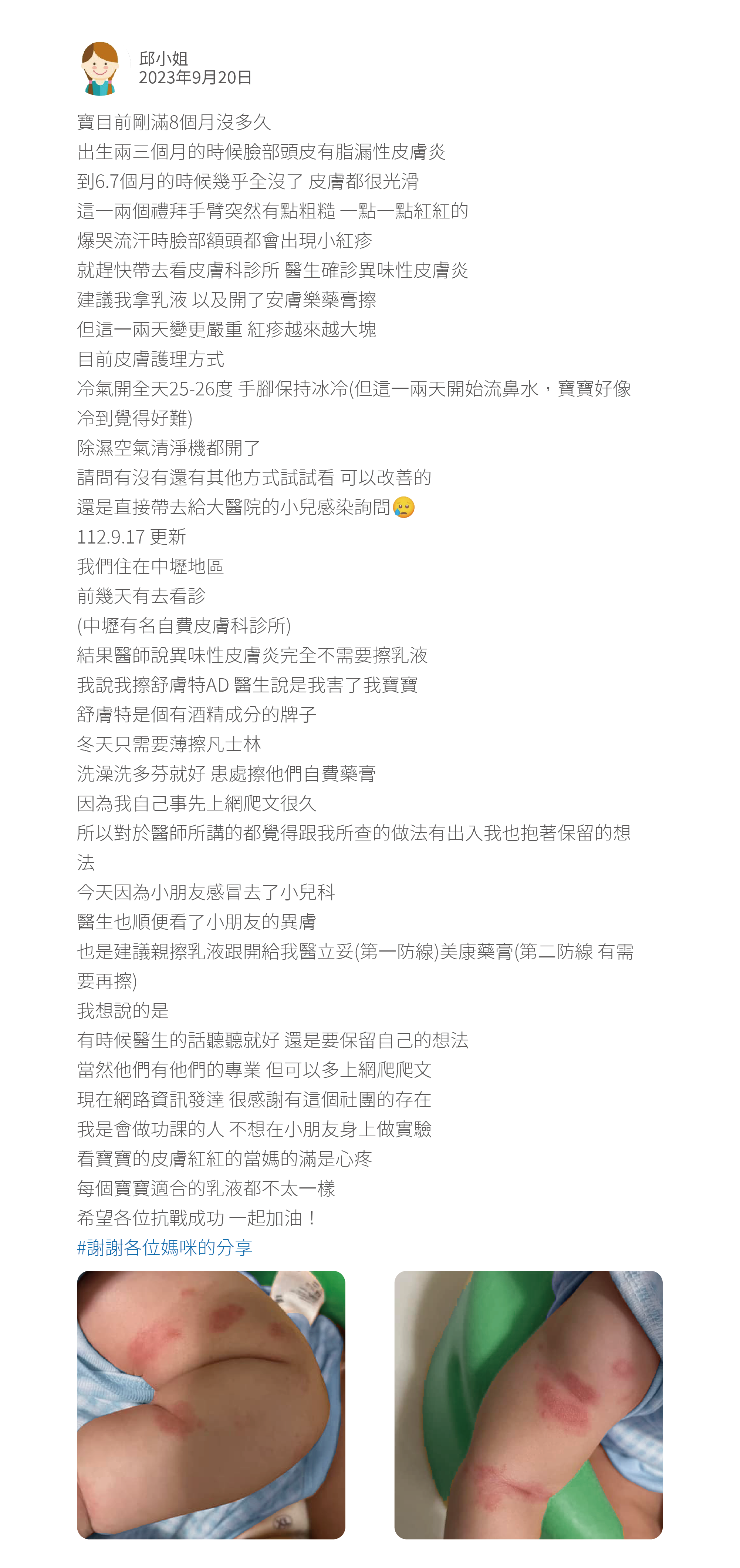 寶目前剛滿8個月沒多久 出生兩三個月的時候臉部頭皮有脂漏性皮膚炎 到6.7個月的時候幾乎全沒了 皮膚都很光滑 這一兩個禮拜手臂突然有點粗糙 一點一點紅紅的 爆哭流汗時臉部額頭都會出現小紅疹 就趕快帶去看皮膚科診所 醫生確診異味性皮膚炎 建議我拿乳液 以及開了安膚樂藥膏擦 但這一兩天變更嚴重 紅疹越來越大塊 目前皮膚護理方式  冷氣開全天25-26度 手腳保持冰冷(但這一兩天開始流鼻水，寶寶好像冷到覺得好難) 除濕空氣清淨機都開了 請問有沒有還有其他方式試試看 可以改善的 還是直接帶去給大醫院的小兒感染詢問 112.9.17 更新 我們住在中壢地區 前幾天有去看診 (中壢有名自費皮膚科診所) 結果醫師說異味性皮膚炎完全不需要擦乳液 我說我擦舒膚特AD 醫生說是我害了我寶寶 舒膚特是個有酒精成分的牌子 冬天只需要薄擦凡士林  洗澡洗多芬就好 患處擦他們自費藥膏 因為我自己事先上網爬文很久  所以對於醫師所講的都覺得跟我所查的做法有出入我也抱著保留的想法 今天因為小朋友感冒去了小兒科 醫生也順便看了小朋友的異膚 也是建議親擦乳液跟開給我醫立妥(第一防線)美康藥膏(第二防線 有需要再擦) 我想說的是 有時候醫生的話聽聽就好 還是要保留自己的想法 當然他們有他們的專業 但可以多上網爬爬文  現在網路資訊發達 很感謝有這個社團的存在 我是會做功課的人 不想在小朋友身上做實驗 看寶寶的皮膚紅紅的當媽的滿是心疼 每個寶寶適合的乳液都不太一樣 希望各位抗戰成功 一起加油！ #謝謝各位媽咪的分享