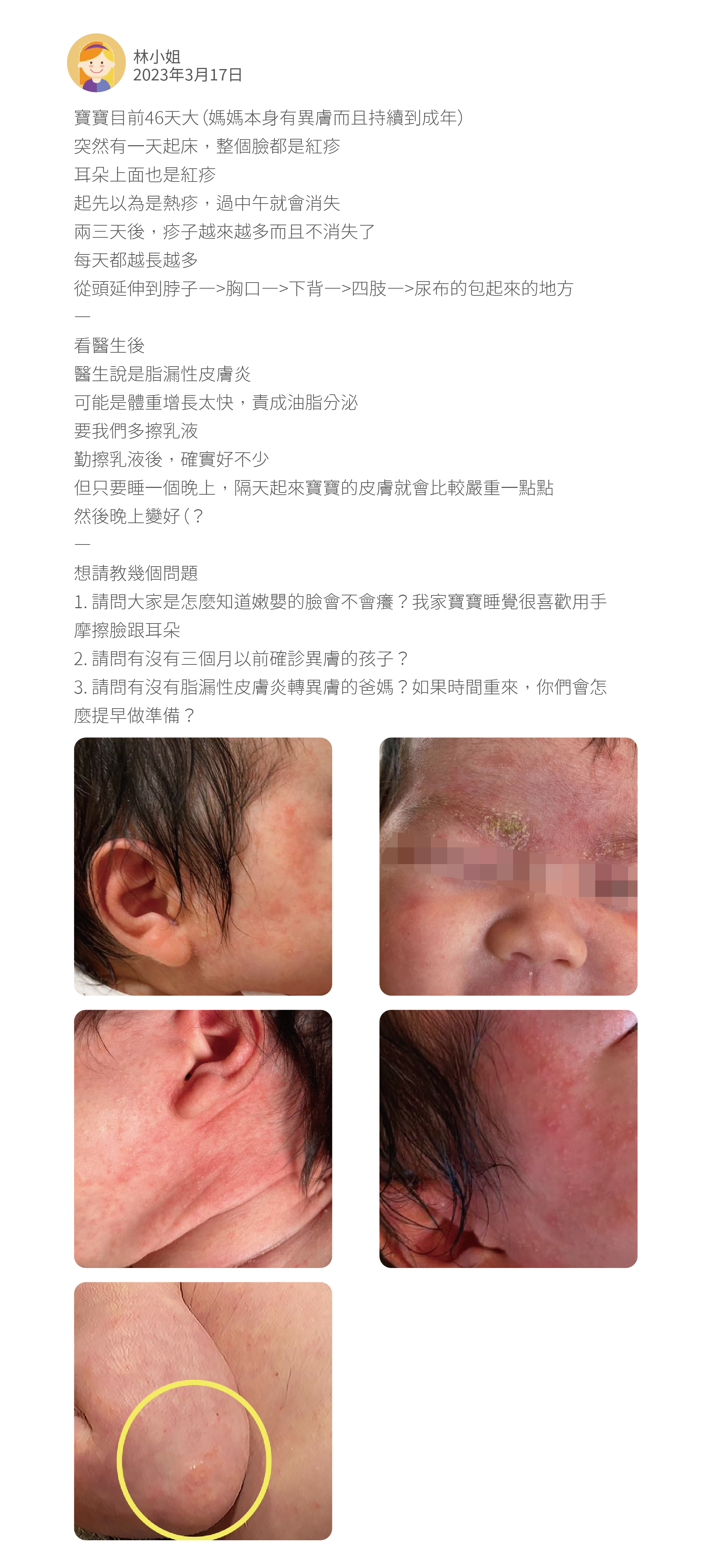 寶寶目前46天大（媽媽本身有異膚而且持續到成年） 突然有一天起床，整個臉都是紅疹 耳朵上面也是紅疹 起先以為是熱疹，過中午就會消失 兩三天後，疹子越來越多而且不消失了 每天都越長越多 從頭延伸到脖子—>胸口—>下背—>四肢—>尿布的包起來的地方 — 看醫生後 醫生說是脂漏性皮膚炎 可能是體重增長太快，責成油脂分泌 要我們多擦乳液 勤擦乳液後，確實好不少 但只要睡一個晚上，隔天起來寶寶的皮膚就會比較嚴重一點點 然後晚上變好（？ — 想請教幾個問題 1. 請問大家是怎麼知道嫩嬰的臉會不會癢？我家寶寶睡覺很喜歡用手摩擦臉跟耳朵 2. 請問有沒有三個月以前確診異膚的孩子？ 3. 請問有沒有脂漏性皮膚炎轉異膚的爸媽？如果時間重來，你們會怎麼提早做準備？
