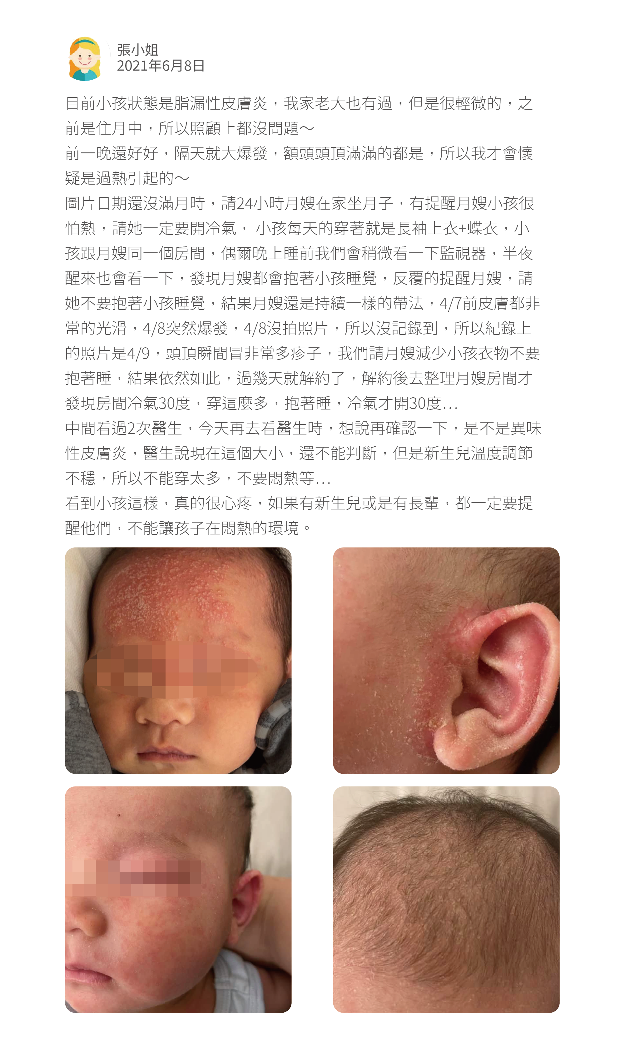 目前小孩狀態是脂漏性皮膚炎,我家老大也有過,但是很輕微的,之前是住月中,所以照顧上都沒問題~ 前一晚還好好,隔天就大爆發,額頭頭頂滿滿的都是,所以我才會懷疑是過熱引起的~ 圖片日期還沒滿月時,請24小時月嫂在家坐月子,有提醒月嫂小孩很怕熱,請她一定要開冷氣, 小孩每天的穿著就是長袖上衣+蝶衣,小孩跟月嫂同一個房間,偶爾晚上睡前我們會稍微看一下監視器,半夜醒來也會看一下,發現月嫂都會抱著小孩睡覺,反覆的提醒月嫂,請她不要抱著小孩睡覺,結果月嫂還是持續一樣的帶法,4/7前皮膚都非常的光滑,4/8突然爆發,4/8沒拍照片,所以沒記錄到,所以紀錄上的照片是4/9,頭頂瞬間冒非常多疹子,我們請月嫂減少小孩衣物不要抱著睡,結果依然如此,過幾天就解約了,解約後去整理月嫂房間才發現房間冷氣30度,穿這麼多,抱著睡,冷氣才開30度⋯ 中間看過2次醫生,今天再去看醫生時,想說再確認一下,是不是異味性皮膚炎,醫生說現在這個大小,還不能判斷,但是新生兒溫度調節不穩,所以不能穿太多,不要悶熱等⋯ 看到小孩這樣,真的很心疼,如果有新生兒或是有長輩,都一定要提醒他們,不能讓孩子在悶熱的環境。