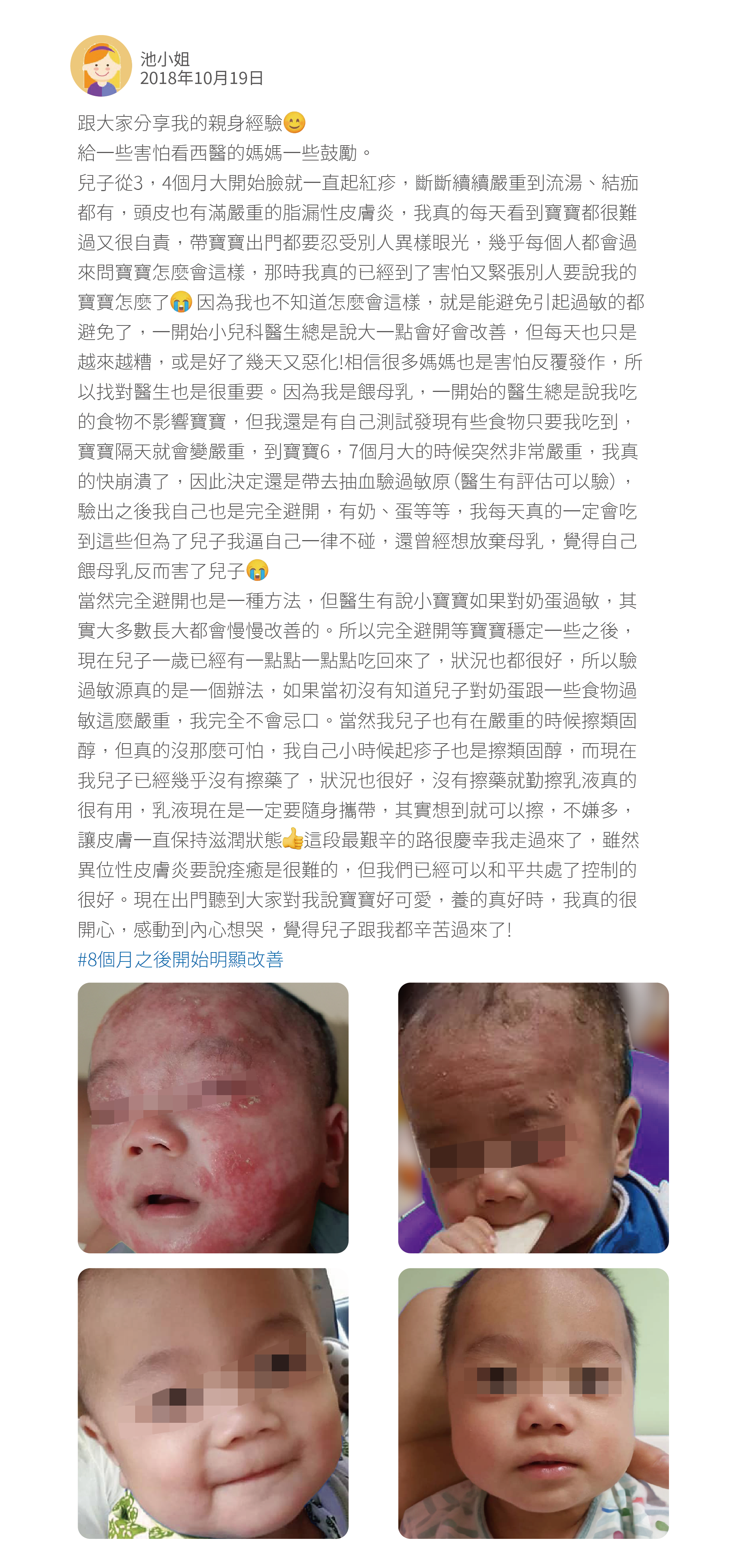 跟大家分享我的親身經驗 給一些害怕看西醫的媽媽一些鼓勵。 兒子從3，4個月大開始臉就一直起紅疹，斷斷續續嚴重到流湯、結痂都有，頭皮也有滿嚴重的脂漏性皮膚炎，我真的每天看到寶寶都很難過又很自責，帶寶寶出門都要忍受別人異樣眼光，幾乎每個人都會過來問寶寶怎麼會這樣，那時我真的已經到了害怕又緊張別人要說我的寶寶怎麼了     因為我也不知道怎麼會這樣，就是能避免引起過敏的都避免了，一開始小兒科醫生總是說大一點會好會改善，但每天也只是越來越糟，或是好了幾天又惡化!相信很多媽媽也是害怕反覆發作，所以找對醫生也是很重要。因為我是餵母乳，一開始的醫生總是說我吃的食物不影響寶寶，但我還是有自己測試發現有些食物只要我吃到，寶寶隔天就會變嚴重，到寶寶6，7個月大的時候突然非常嚴重，我真的快崩潰了，因此決定還是帶去抽血驗過敏原（醫生有評估可以驗），驗出之後我自己也是完全避開，有奶、蛋等等，我每天真的一定會吃到這些但為了兒子我逼自己一律不碰，還曾經想放棄母乳，覺得自己餵母乳反而害了兒子 當然完全避開也是一種方法，但醫生有說小寶寶如果對奶蛋過敏，其實大多數長大都會慢慢改善的。所以完全避開等寶寶穩定一些之後，現在兒子一歲已經有一點點一點點吃回來了，狀況也都很好，所以驗過敏源真的是一個辦法，如果當初沒有知道兒子對奶蛋跟一些食物過敏這麼嚴重，我完全不會忌口。當然我兒子也有在嚴重的時候擦類固醇，但真的沒那麼可怕，我自己小時候起疹子也是擦類固醇，而現在我兒子已經幾乎沒有擦藥了，狀況也很好，沒有擦藥就勤擦乳液真的很有用，乳液現在是一定要隨身攜帶，其實想到就可以擦，不嫌多，讓皮膚一直保持滋潤狀態    這段最艱辛的路很慶幸我走過來了，雖然異位性皮膚炎要說痊癒是很難的，但我們已經可以和平共處了控制的很好。現在出門聽到大家對我說寶寶好可愛，養的真好時，我真的很開心，感動到內心想哭，覺得兒子跟我都辛苦過來了! #8個月之後開始明顯改善