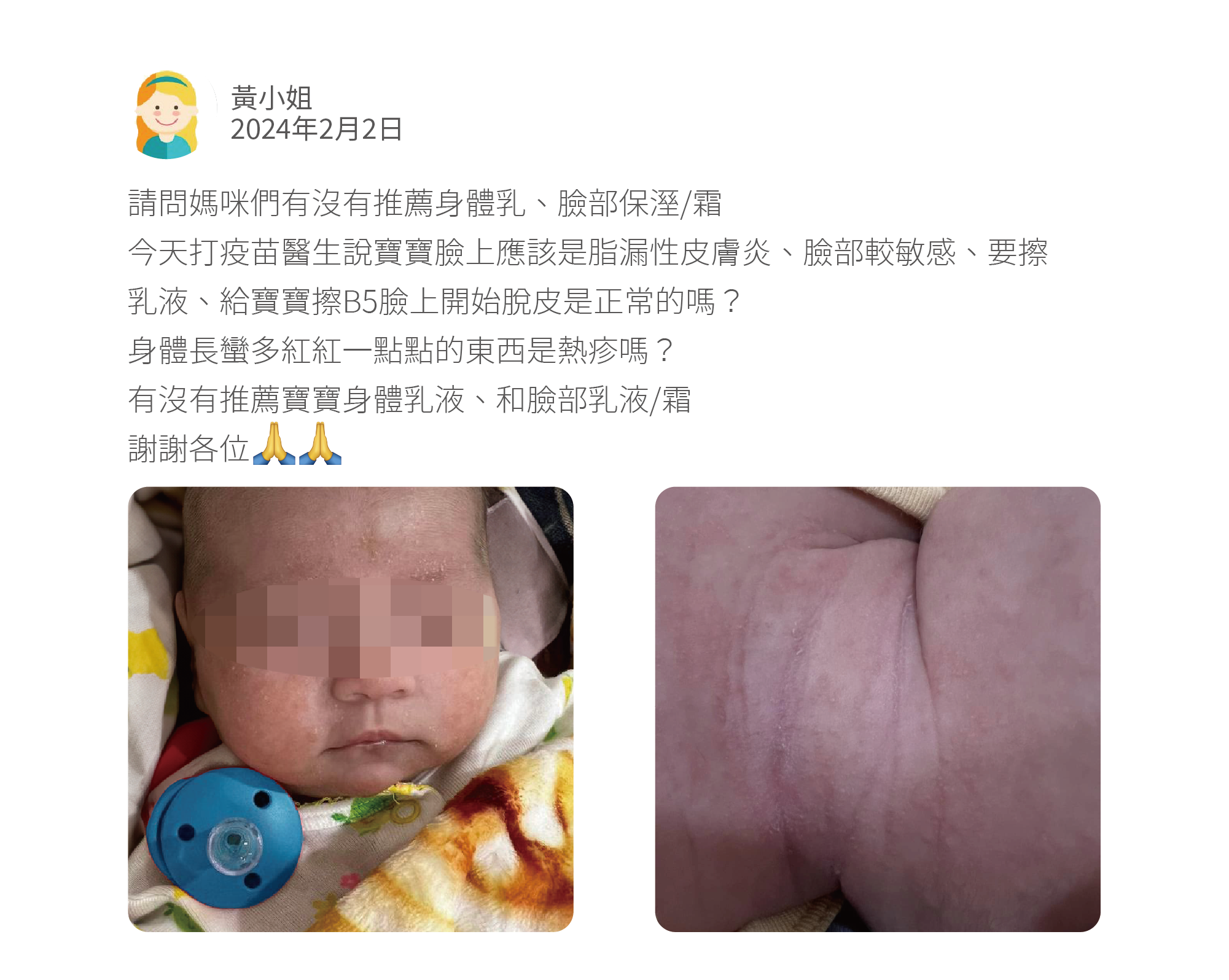 請問媽咪們有沒有推薦身體乳、臉部保溼/霜 今天打疫苗醫生說寶寶臉上應該是脂漏性皮膚炎、臉部較敏感、要擦乳液、給寶寶擦B5臉上開始脫皮是正常的嗎? 身體長蠻多紅紅一點點的東西是熱疹嗎? 有沒有推薦寶寶身體乳液、和臉部乳液/霜 謝謝各位