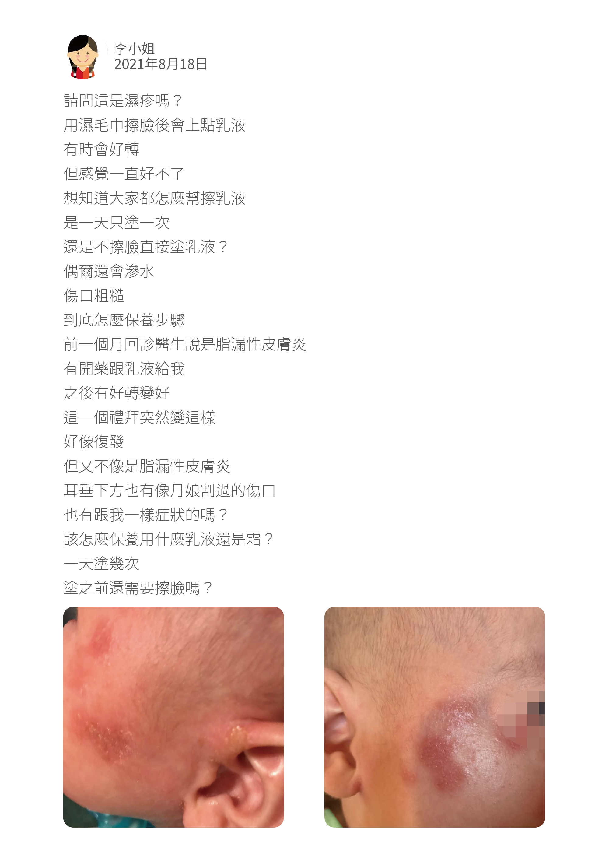 請問這是濕疹嗎? 用濕毛巾擦臉後會上點乳液 有時會好轉 但感覺一直好不了 想知道大家都怎麼幫擦乳液 是一天只塗一次 還是不擦臉直接塗乳液? 偶爾還會滲水 傷口粗糙 到底怎麼保養步驟 前一個月回診醫生說是脂漏性皮膚炎 有開藥跟乳液給我 之後有好轉變好 這一個禮拜突然變這樣 好像復發 但又不像是脂漏性皮膚炎 耳垂下方也有像月娘割過的傷口 也有跟我一樣症狀的嗎? 該怎麼保養用什麼乳液還是霜? 一天塗幾次 塗之前還需要擦臉嗎?
