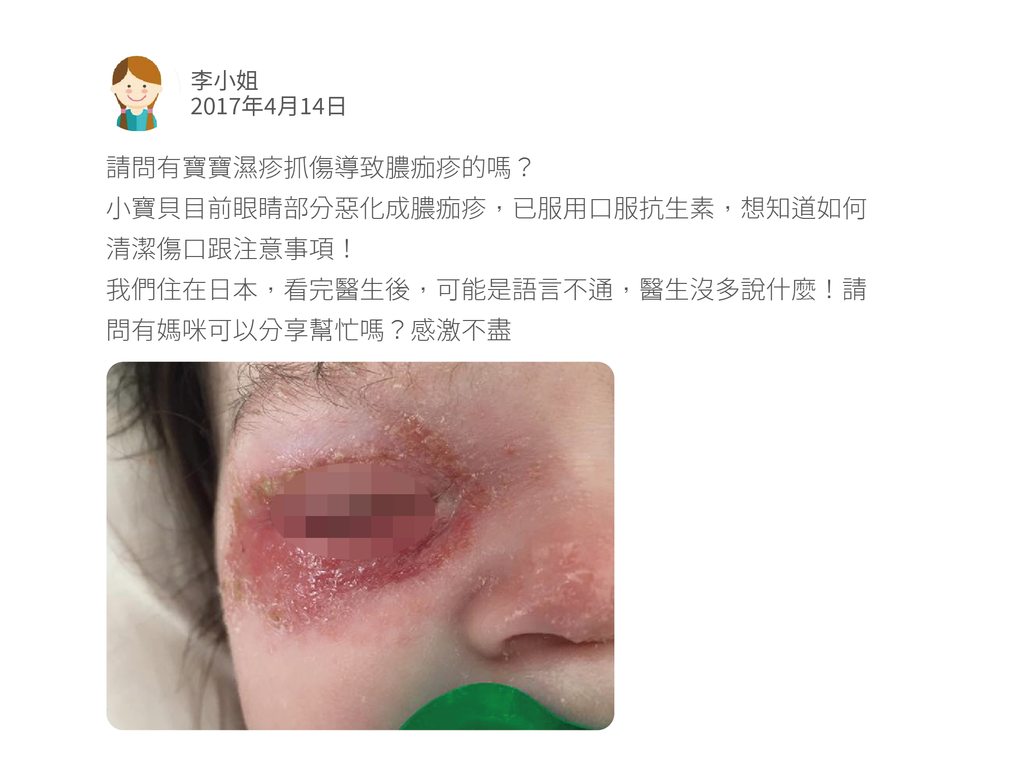 請問有寶寶濕疹抓傷導致膿痂疹的嗎？ 小寶貝目前眼睛部分惡化成膿痂疹，已服用口服抗生素，想知道如何清潔傷口跟注意事項！ 我們住在日本，看完醫生後，可能是語言不通，醫生沒多說什麼！請問有媽咪可以分享幫忙嗎？感激不盡
