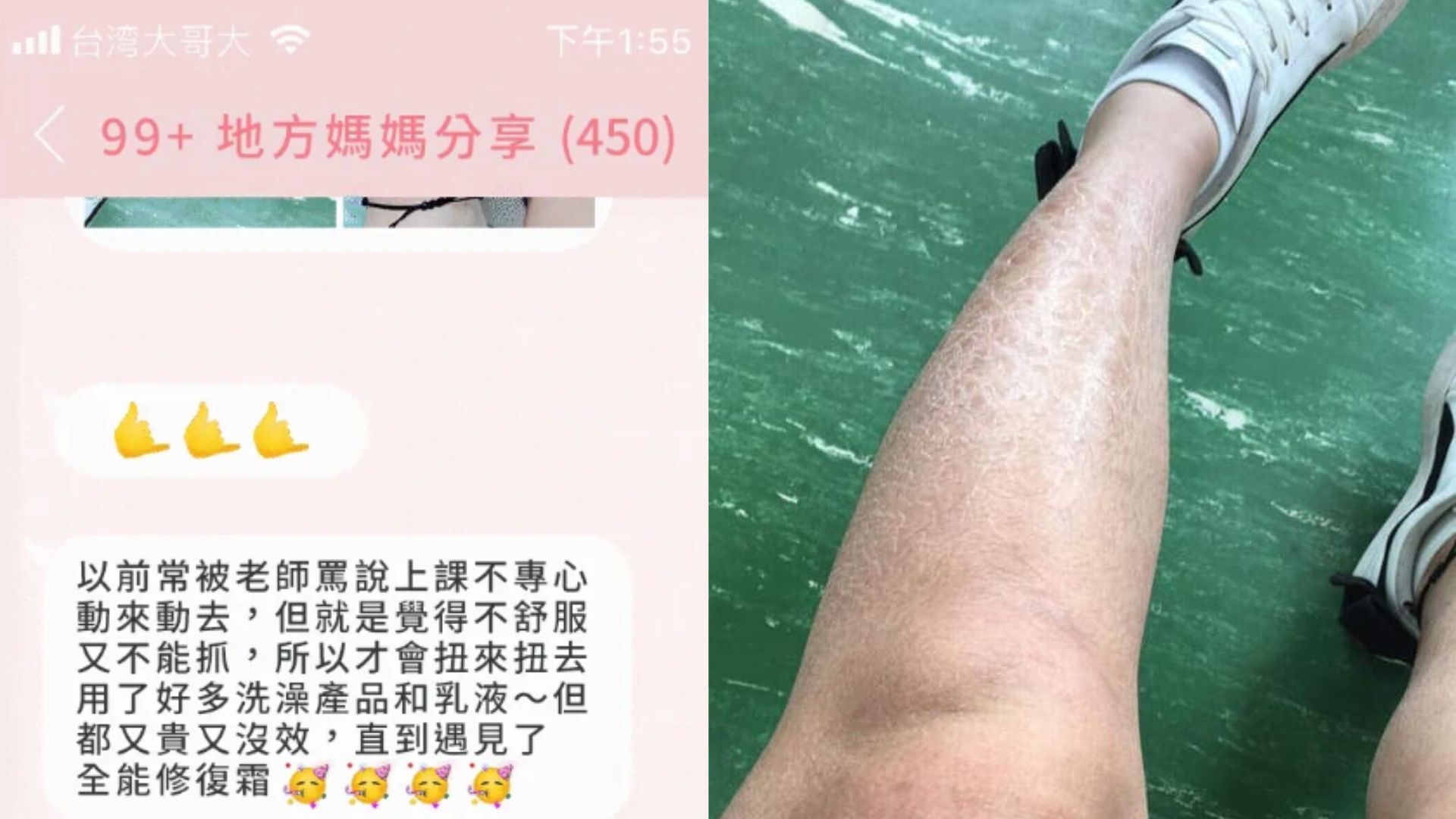 媽媽群推爆!秀出女兒腿部慘狀,用了薇佳修復霜終於不用抓不停。