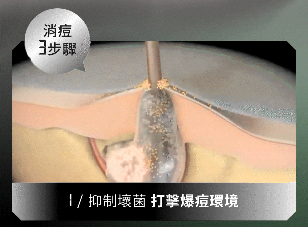 消痘三步驟：抑制壞菌、減少毛孔堵油、清理痘後戰場 淡印嫩膚