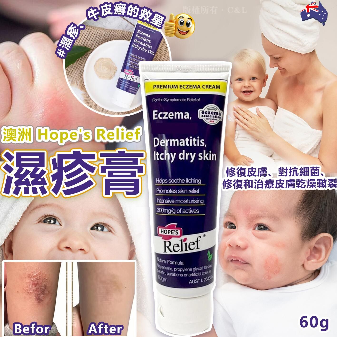 澳洲 Hope's Relief 濕疹膏60g