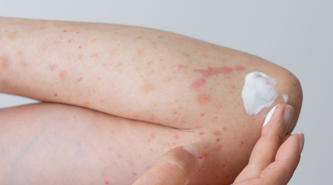 皮膚很癢一粒一粒紅紅的？你是否曾經為突如其來的皮膚紅腫突起、發癢或脫皮感到困擾？皮膚過敏不僅影響外觀，還可能降低生活品質，讓人焦慮不安。無論是環境變化、飲食因素，還是化學物質刺激，過敏的成因多種多樣