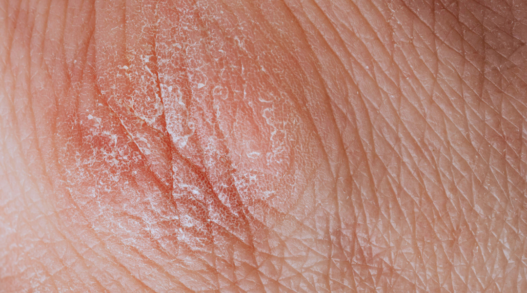 你是否經常感到臉部乾燥、泛紅、發癢，卻不確定自己是敏感肌還是皮膚過敏？這兩種情況雖然症狀類似，但成因卻大不相同，錯誤判斷可能導致護膚方式不當，讓肌膚問題惡化。   「為什麼我的皮膚總是發紅、發癢、長紅疹，甚至脫皮？是不是敏感肌？」許多人一遇