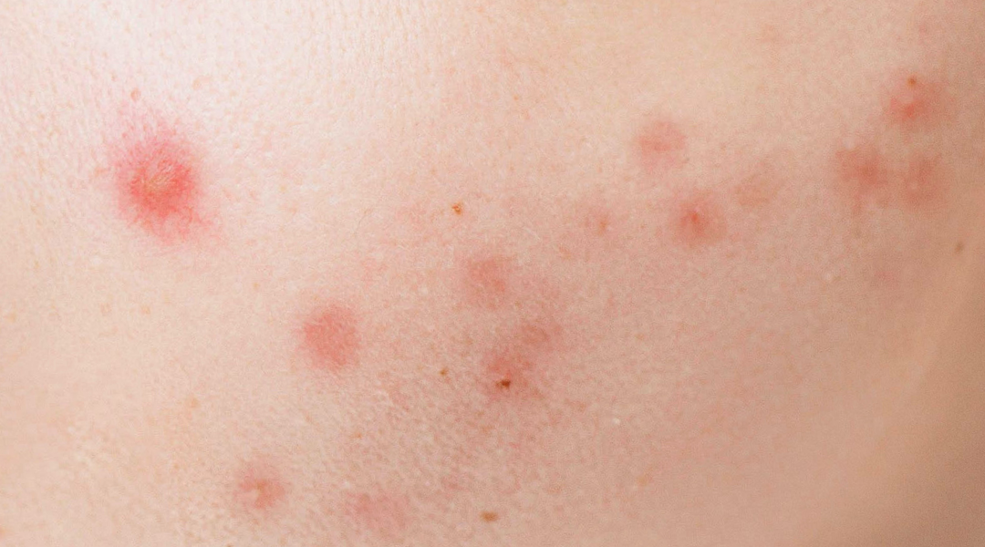 皮膚紅腫癢硬塊怎麼辦？皮膚是人體最大的器官，也是最容易受到外界刺激的屏障。許多人都曾經歷過皮膚紅腫突起痛的症狀，尤其當紅腫發癢發熱刺痛時，可能嚴重影響日常生活。如果未能及時處理，甚至可能惡化為更嚴重的皮膚問題。