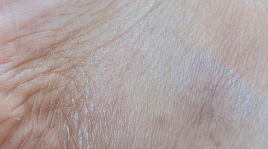 皮膚乾燥困擾著許多人，不僅帶來脫皮、緊繃等不適，更可能引發嚴重的皮膚問題。您是否也深受皮膚乾燥之苦？想知道皮膚乾燥脫皮的原因？如何有效改善皮膚太乾的狀況？皮膚乾燥可以吃什麼來改善？