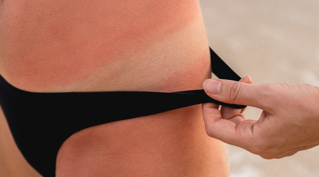 長時間暴露在大白天陽光下，皮膚很容易變得泛紅、乾燥、暗沉，甚至曬黑、曬傷。許多人在曬後匆忙塗抹美白產品，但卻發現效果不如預期，甚至導致肌膚敏感。那麼，該如何做好曬後護理，才能讓肌膚迅速恢復水潤透亮？