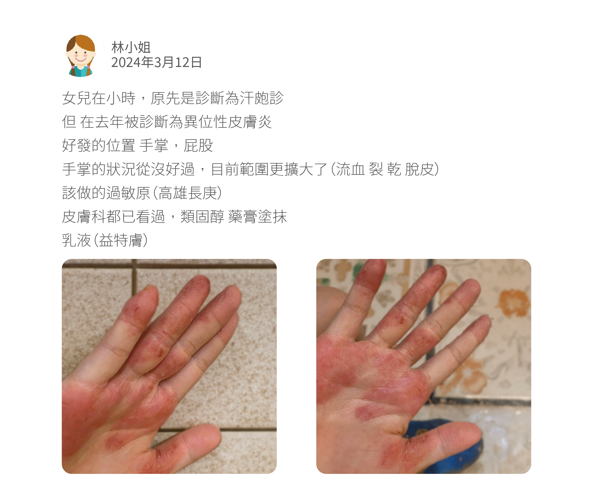 女兒在小時,原先是診斷為汗皰診 但 在去年被診斷為異位性皮膚炎 好發的位置 手掌,屁股 手掌的狀況從沒好過,目前範圍更擴大了(流血 裂 乾 脫皮) 該做的過敏原(高雄長庚) 皮膚科都已看過,類固醇 藥膏塗抹 乳液(益特膚)