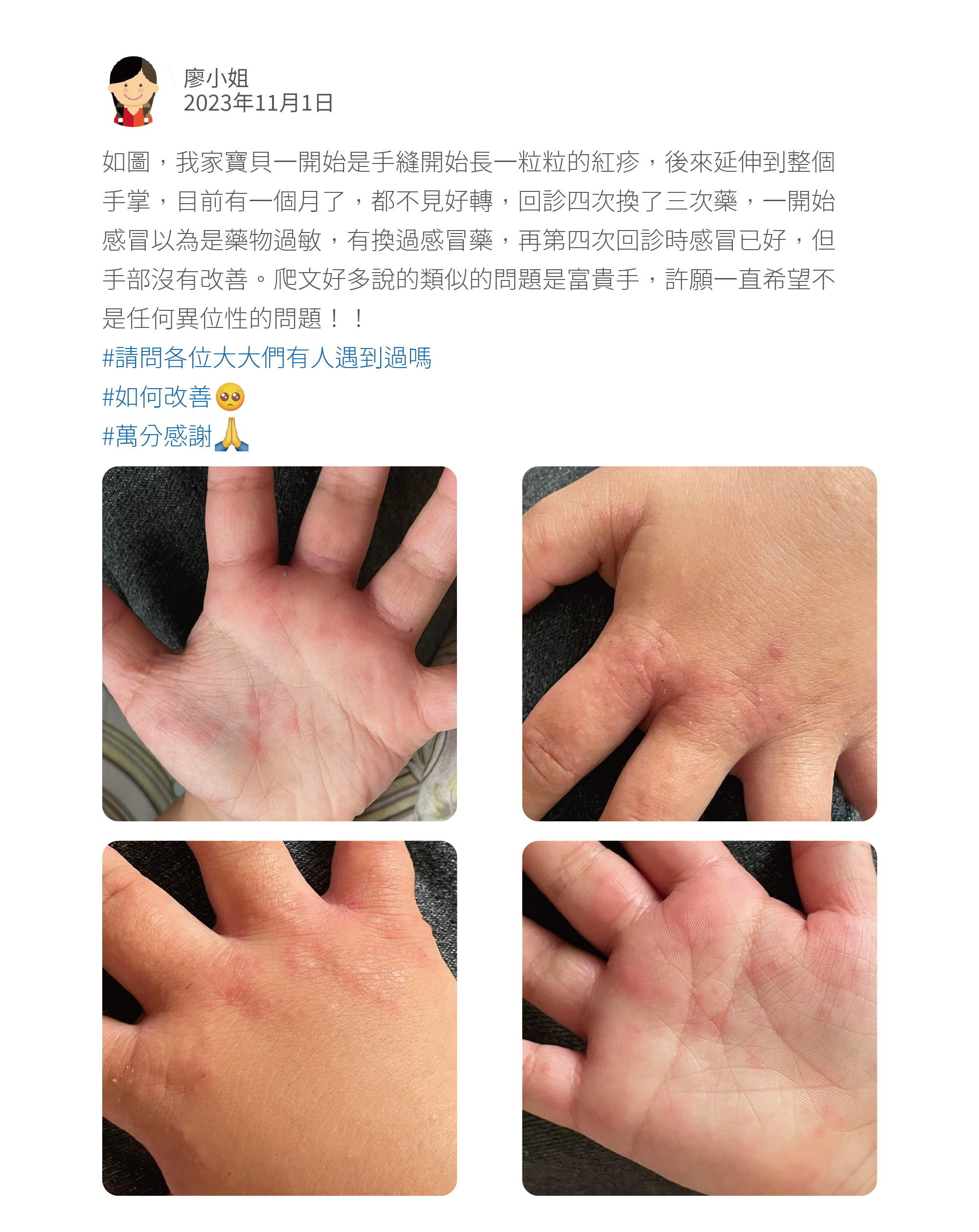如圖,我家寶貝一開始是手縫開始長一粒粒的紅疹,後來延伸到整個手掌,目前有一個月了,都不見好轉,回診四次換了三次藥,一開始感冒以為是藥物過敏,有換過感冒藥,再第四次回診時感冒已好,但手部沒有改善。爬文好多說的類似的問題是富貴手,許願一直希望不是任何異位性的問題!! #請問各位大大們有人遇到過嗎 #如何改善 #萬分感謝