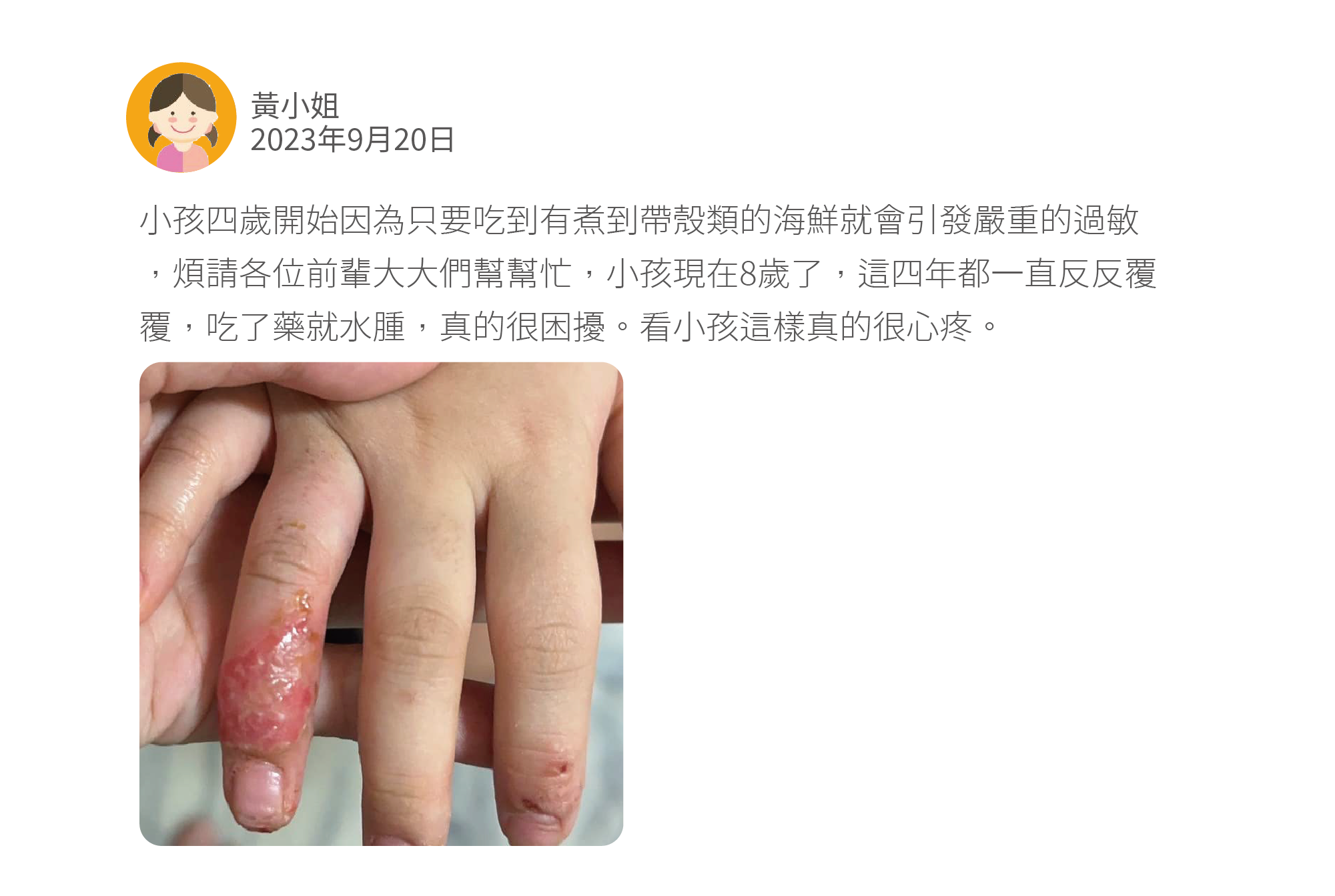 小孩四歲開始因為只要吃到有煮到帶殼類的海鮮就會引發嚴重的過敏,煩請各位前輩大大們幫幫忙,小孩現在8歲了,這四年都一直反反覆覆,吃了藥就水腫,真的很困擾。看小孩這樣真的很心疼。