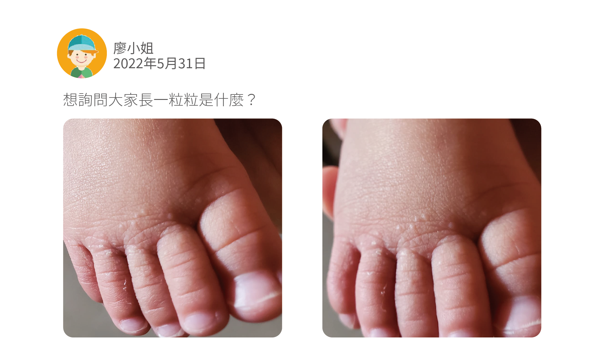 想詢問大家長一粒粒是什麼?