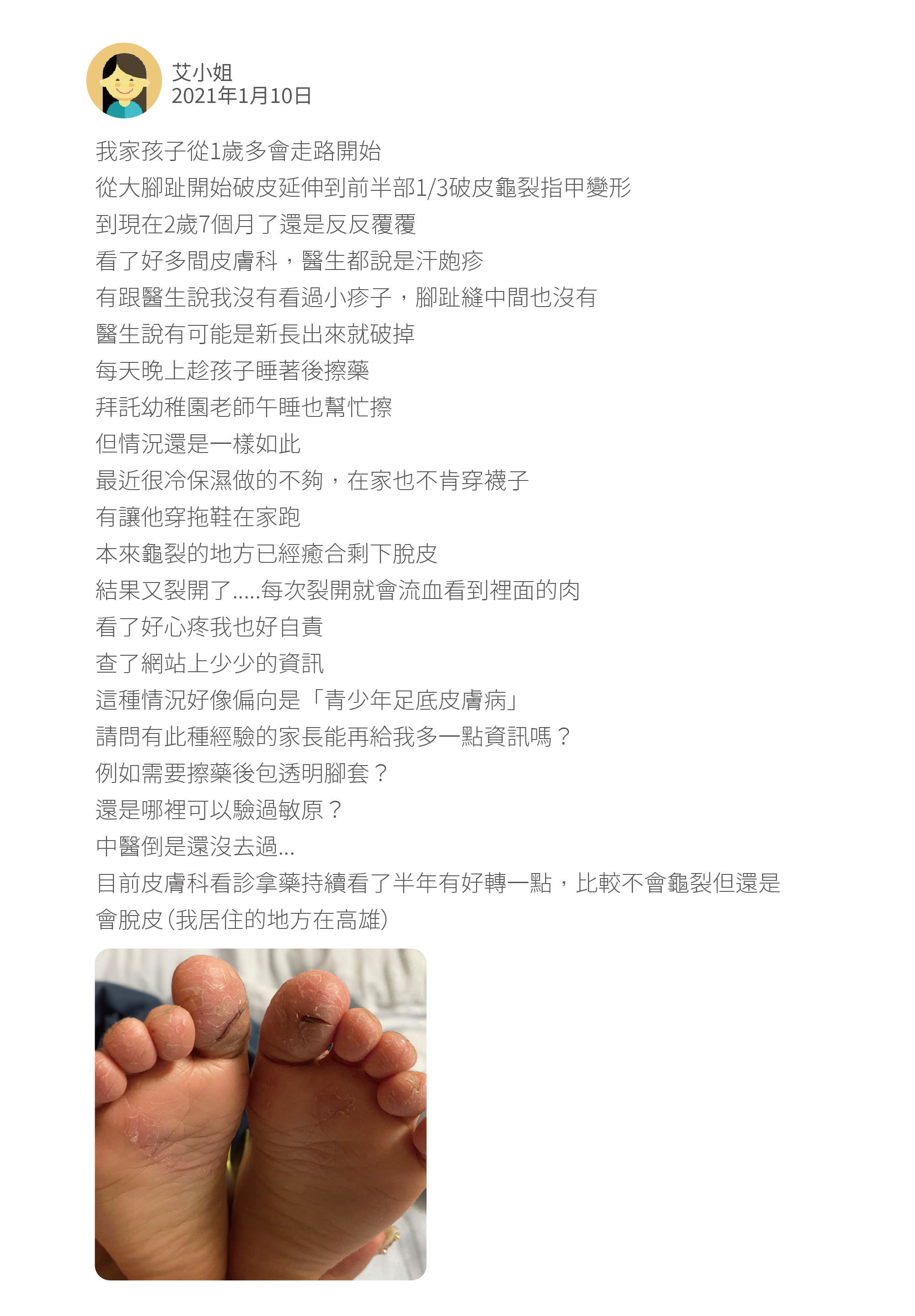 我家孩子從1歲多會走路開始 從大腳趾開始破皮延伸到前半部1/3破皮龜裂指甲變形 到現在2歲7個月了還是反反覆覆 看了好多間皮膚科，醫生都說是汗皰疹 有跟醫生說我沒有看過小疹子，腳趾縫中間也沒有 醫生說有可能是新長出來就破掉 每天晚上趁孩子睡著後擦藥 拜託幼稚園老師午睡也幫忙擦 但情況還是一樣如此 最近很冷保濕做的不夠，在家也不肯穿襪子 有讓他穿拖鞋在家跑 本來龜裂的地方已經癒合剩下脫皮 結果又裂開了.....每次裂開就會流血看到裡面的肉 看了好心疼我也好自責 查了網站上少少的資訊 這種情況好像偏向是「青少年足底皮膚病」 請問有此種經驗的家長能再給我多一點資訊嗎？ 例如需要擦藥後包透明腳套？ 還是哪裡可以驗過敏原？ 中醫倒是還沒去過... 目前皮膚科看診拿藥持續看了半年有好轉一點，比較不會龜裂但還是會脫皮（我居住的地方在高雄）