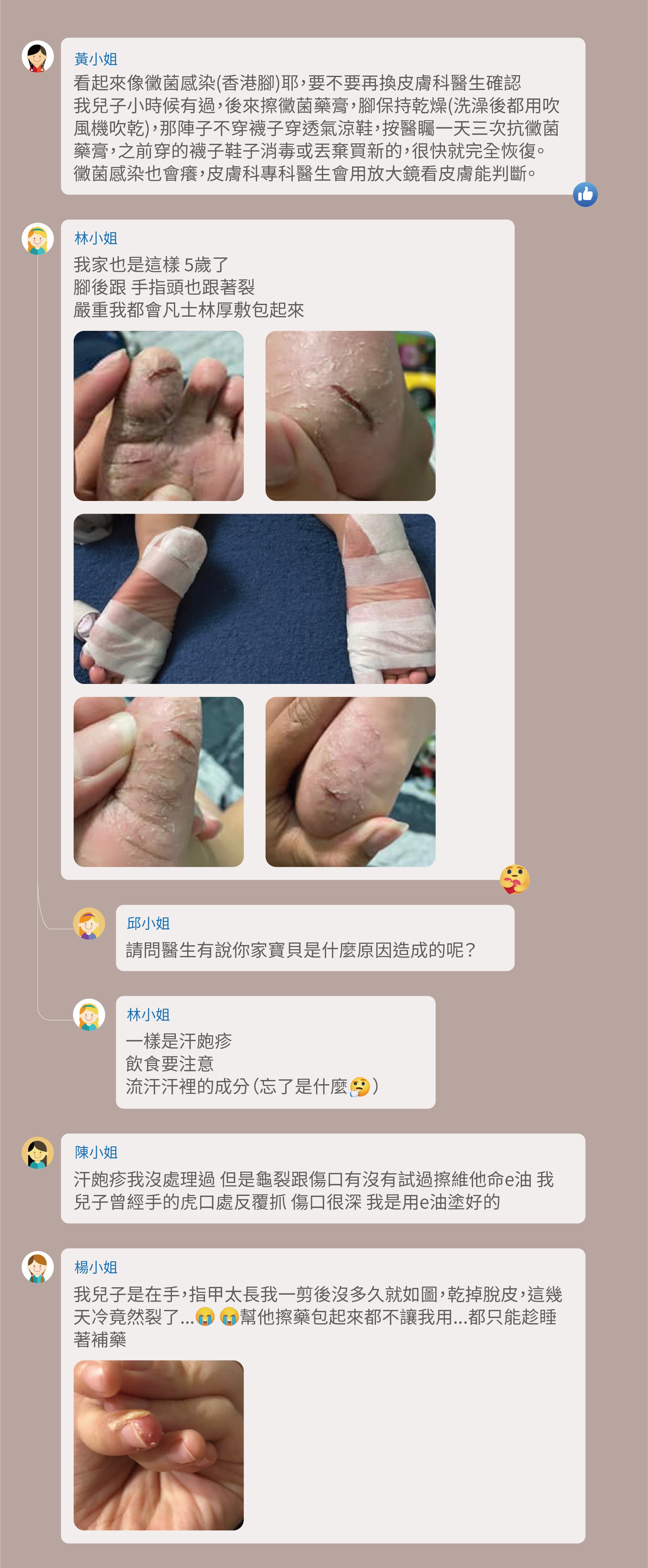 看起來像黴菌感染(香港腳)耶,要不要再換皮膚科醫生確認,我兒子小時候有過,後來擦黴菌藥膏,腳保持乾燥(洗澡後都用吹風機吹乾),那陣子不穿襪子穿透氣涼鞋,按醫矚一天三次抗黴菌藥膏,之前穿的襪子鞋子消毒或丟棄買新的,很快就完全恢復。黴菌感染也會癢,皮膚科專科醫生會用放大鏡看皮膚能判斷。我家也是這樣 5歲了,腳後跟 手指頭也跟著裂,嚴重我都會凡士林厚敷包起來,請問醫生有說你家寶貝是什麼原因造成的呢?一樣是汗皰疹,飲食要注意,流汗汗裡的成分(忘了是什麼 ),汗皰疹我沒處理過 但是龜裂跟傷口有沒有試過擦維他命e油 我兒子曾經手的虎口處反覆抓 傷口很深 我是用e油塗好的,我兒子是在手,指甲太長我一剪後沒多久就如圖,乾掉脫皮,這幾天冷竟然裂了... 幫他擦藥包起來都不讓我用...都只能趁睡著補藥