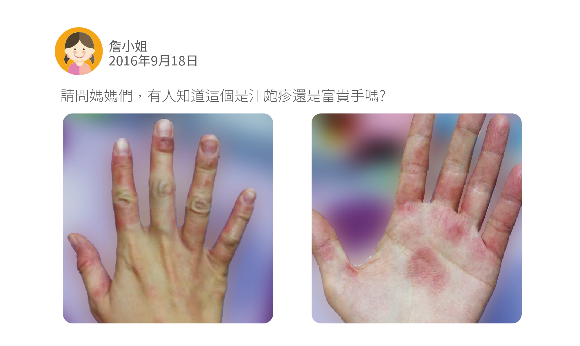 請問媽媽們,有人知道這個是汗皰疹還是富貴手嗎?