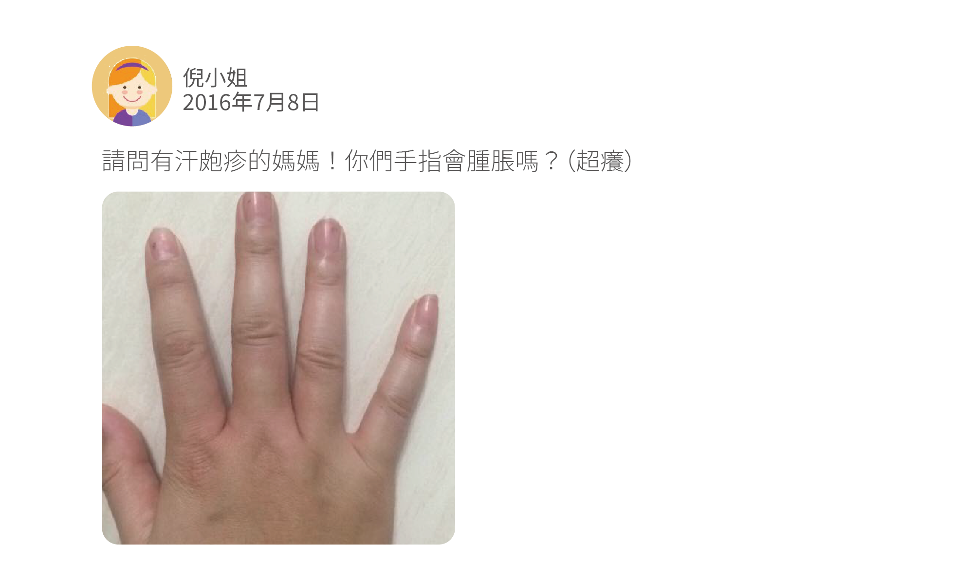 請問有汗皰疹的媽媽！你們手指會腫脹嗎？（超癢）目前不考慮擦類固醇謝謝推薦！