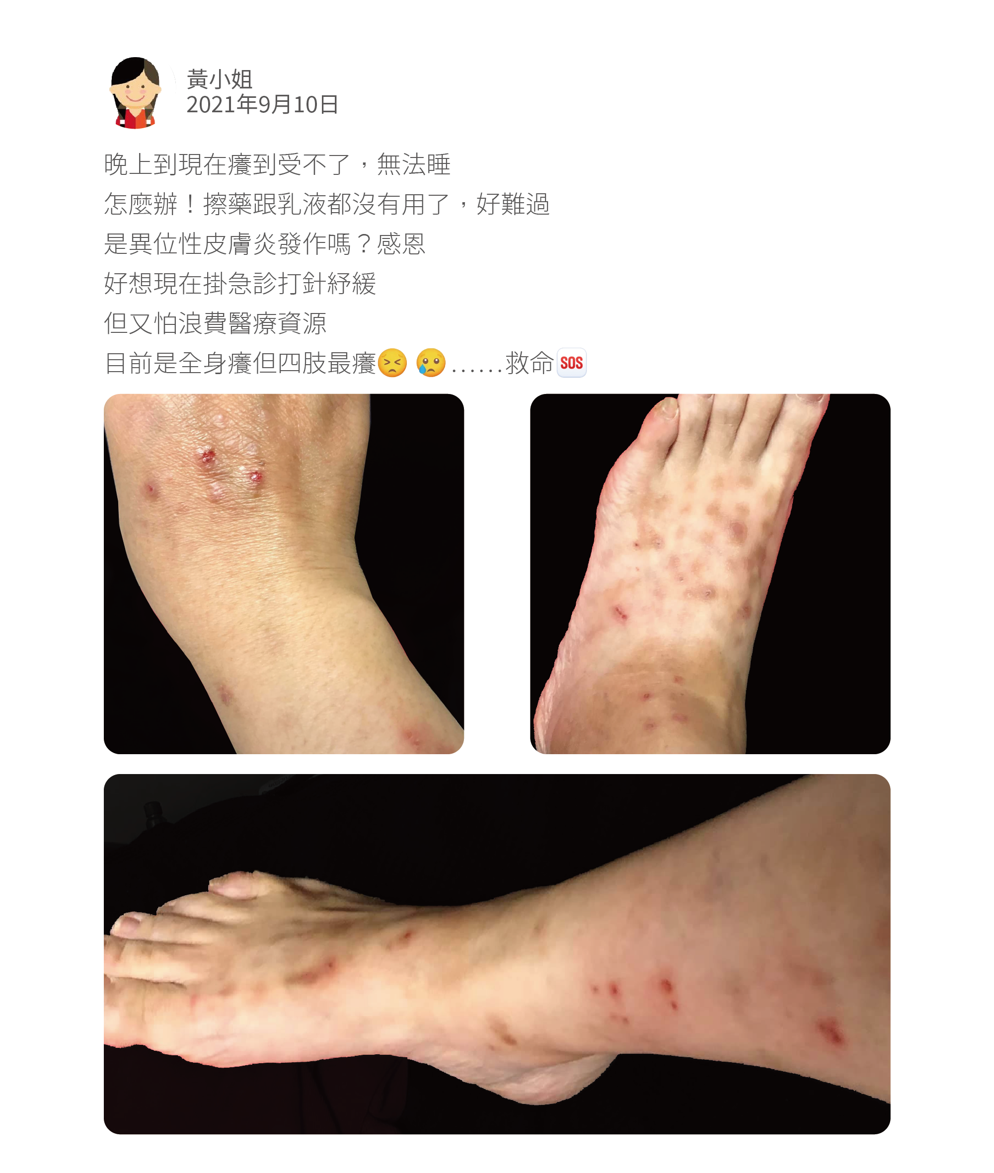 晚上到現在癢到受不了,無法睡 怎麼辦!擦藥跟乳液都沒有用了,好難過 是異位性皮膚炎發作嗎?感恩 好想現在掛急診打針紓緩 但又怕浪費醫療資源 目前是全身癢但四肢最癢 ⋯⋯救命