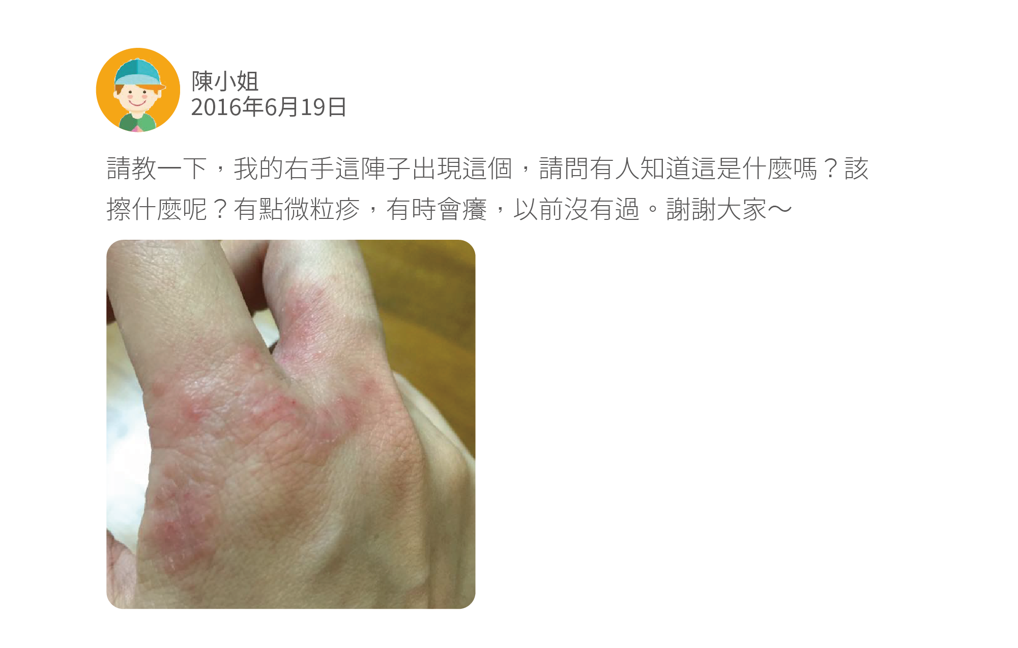 請教一下,我的右手這陣子出現這個,請問有人知道這是什麼嗎?該擦什麼呢?有點微粒疹,有時會癢,以前沒有過。謝謝大家~
