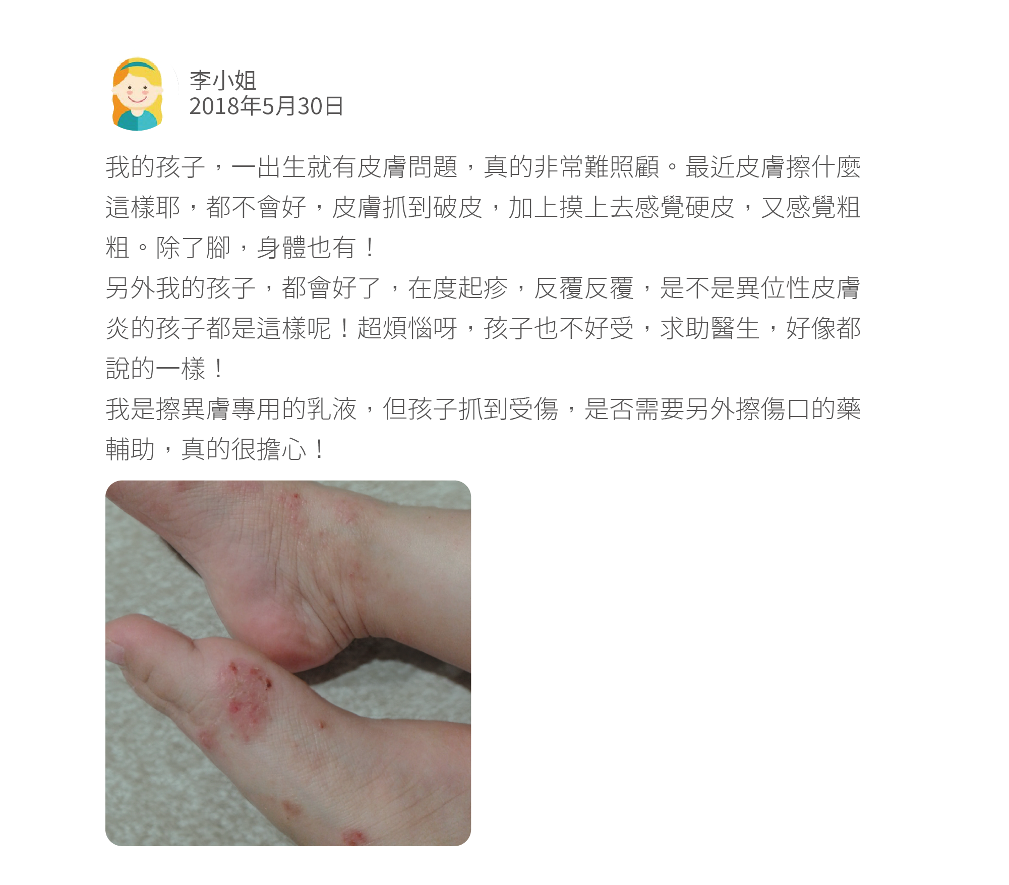 我的孩子，一出生就有皮膚問題，真的非常難照顧。最近皮膚擦什麼這樣耶，都不會好，皮膚抓到破皮，加上摸上去感覺硬皮，又感覺粗粗。除了腳，身體也有！ 另外我的孩子，都會好了，在度起疹，反覆反覆，是不是異位性皮膚炎的孩子都是這樣呢！超煩惱呀，孩子也不好受，求助醫生，好像都說的一樣！ 我是擦異膚專用的乳液，但孩子抓到受傷，是否需要另外擦傷口的藥輔助，真的很擔心！