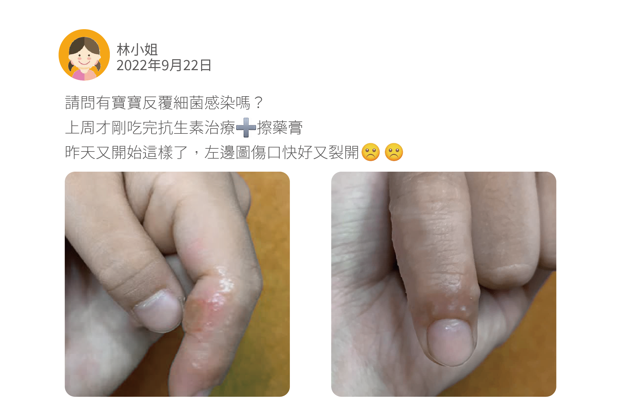 請問有寶寶反覆細菌感染嗎? 上周才剛吃完抗生素治療+擦藥膏 昨天又開始這樣了,左邊圖傷口快好又裂開