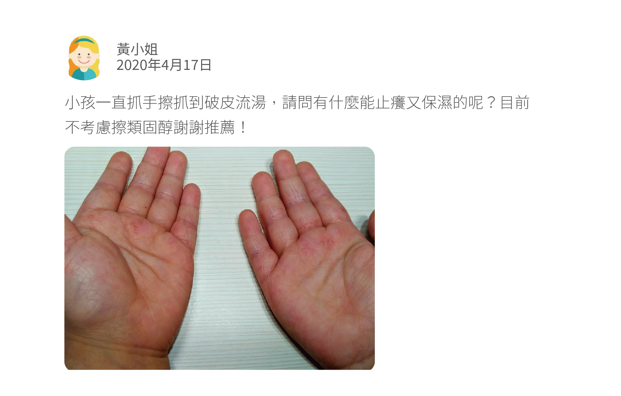 小孩一直抓手擦抓到破皮流湯，請問有什麼能止癢又保濕的呢？目前不考慮擦類固醇謝謝推薦！