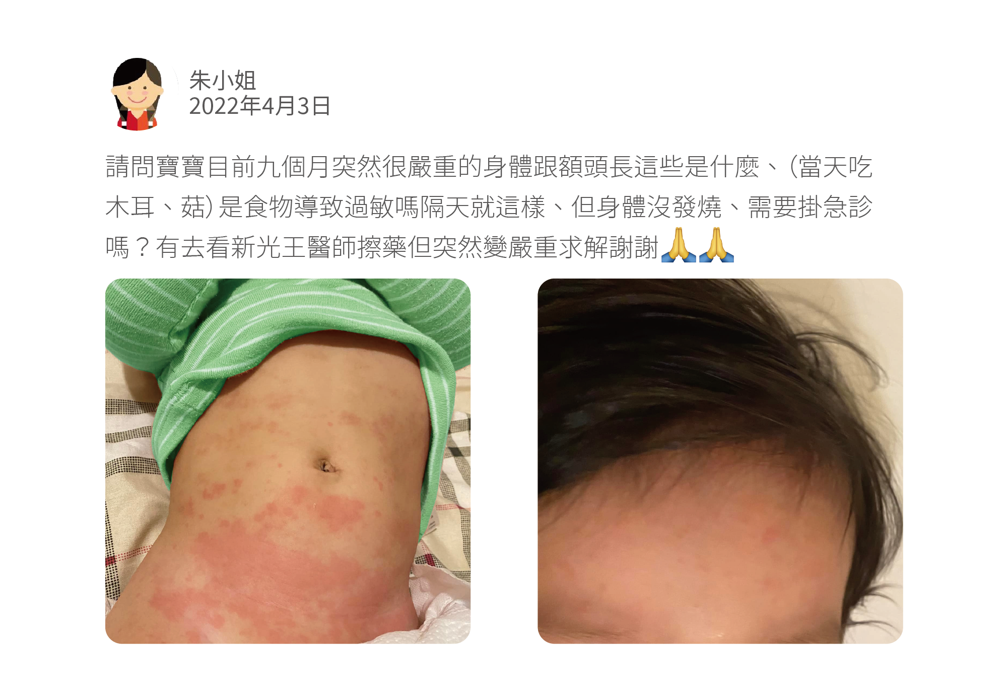 請問寶寶目前九個月突然很嚴重的身體跟額頭長這些是什麼、(當天吃木耳、菇)是食物導致過敏嗎隔天就這樣、但身體沒發燒、需要掛急診嗎?有去看新光王醫師擦藥但突然變嚴重求解謝謝