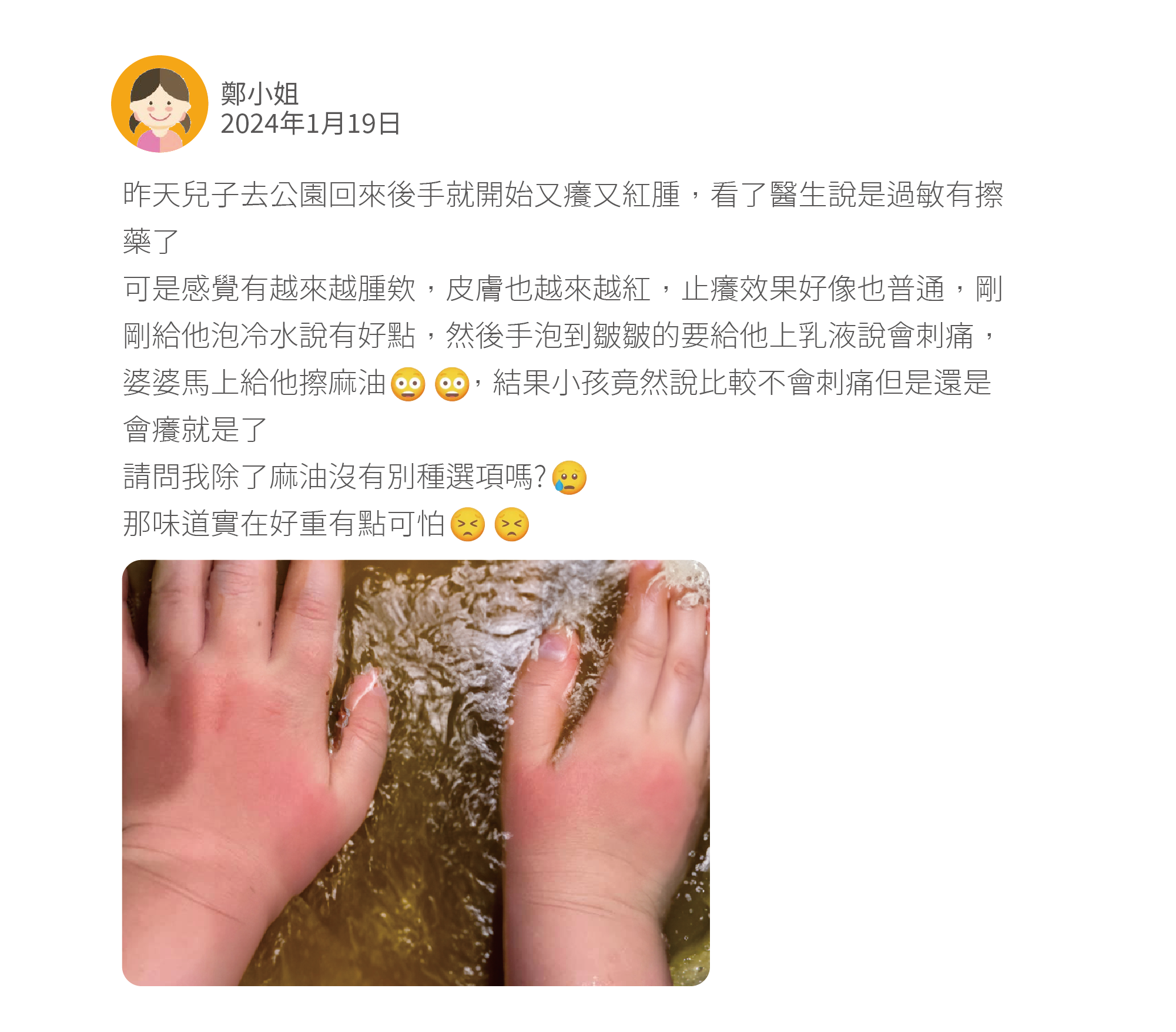 昨天兒子去公園回來後手就開始又癢又紅腫,看了醫生說是過敏有擦藥了 可是感覺有越來越腫欸,皮膚也越來越紅,止癢效果好像也普通,剛剛給他泡冷水說有好點,然後手泡到皺皺的要給他上乳液說會刺痛,婆婆馬上給他擦麻油 ,結果小孩竟然說比較不會刺痛但是還是會癢就是了 請問我除了麻油沒有別種選項嗎? 那味道實在好重有點可怕