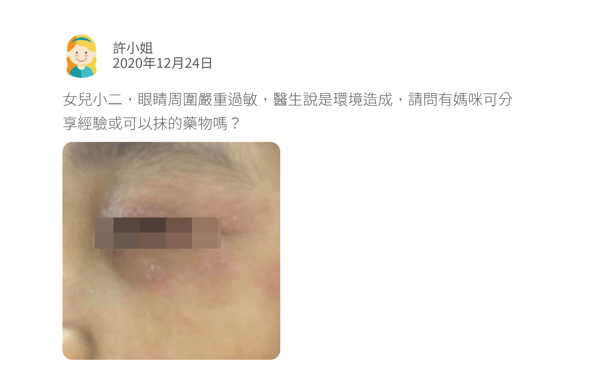 女兒小二,眼睛周圍嚴重過敏,醫生說是環境造成,請問有媽咪可分享經驗或可以抹的藥物嗎?