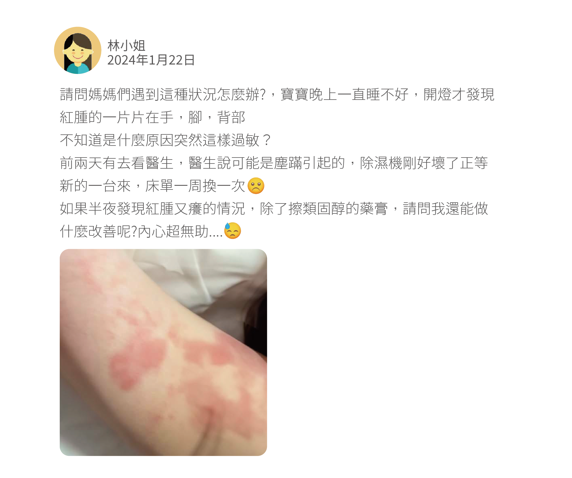 請問媽媽們遇到這種狀況怎麼辦?,寶寶晚上一直睡不好,開燈才發現紅腫的一片片在手,腳,背部 不知道是什麼原因突然這樣過敏? 前兩天有去看醫生,醫生說可能是塵蹣引起的,除濕機剛好壞了正等新的一台來,床單一周換一次 如果半夜發現紅腫又癢的情況,除了擦類固醇的藥膏,請問我還能做什麼改善呢?內心超無助....