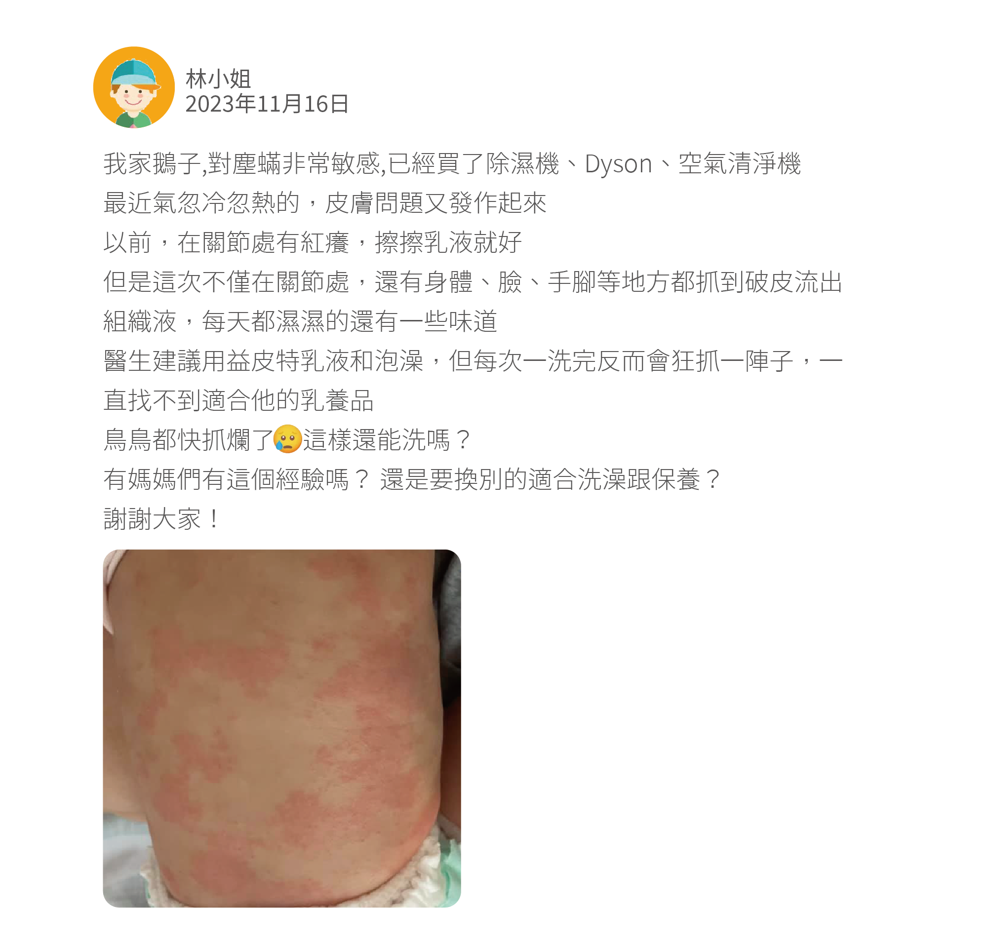 我家鵝子,對塵蟎非常敏感,已經買了除濕機、Dyson、空氣清淨機 最近氣忽冷忽熱的，皮膚問題又發作起來 以前，在關節處有紅癢，擦擦乳液就好 但是這次不僅在關節處，還有身體、臉、手腳等地方都抓到破皮流出組織液，每天都濕濕的還有一些味道 醫生建議用益皮特乳液和泡澡，但每次一洗完反而會狂抓一陣子，一直找不到適合他的乳養品 鳥鳥都快抓爛了    這樣還能洗嗎？ 有媽媽們有這個經驗嗎？ 還是要換別的適合洗澡跟保養？ 謝謝大家！
