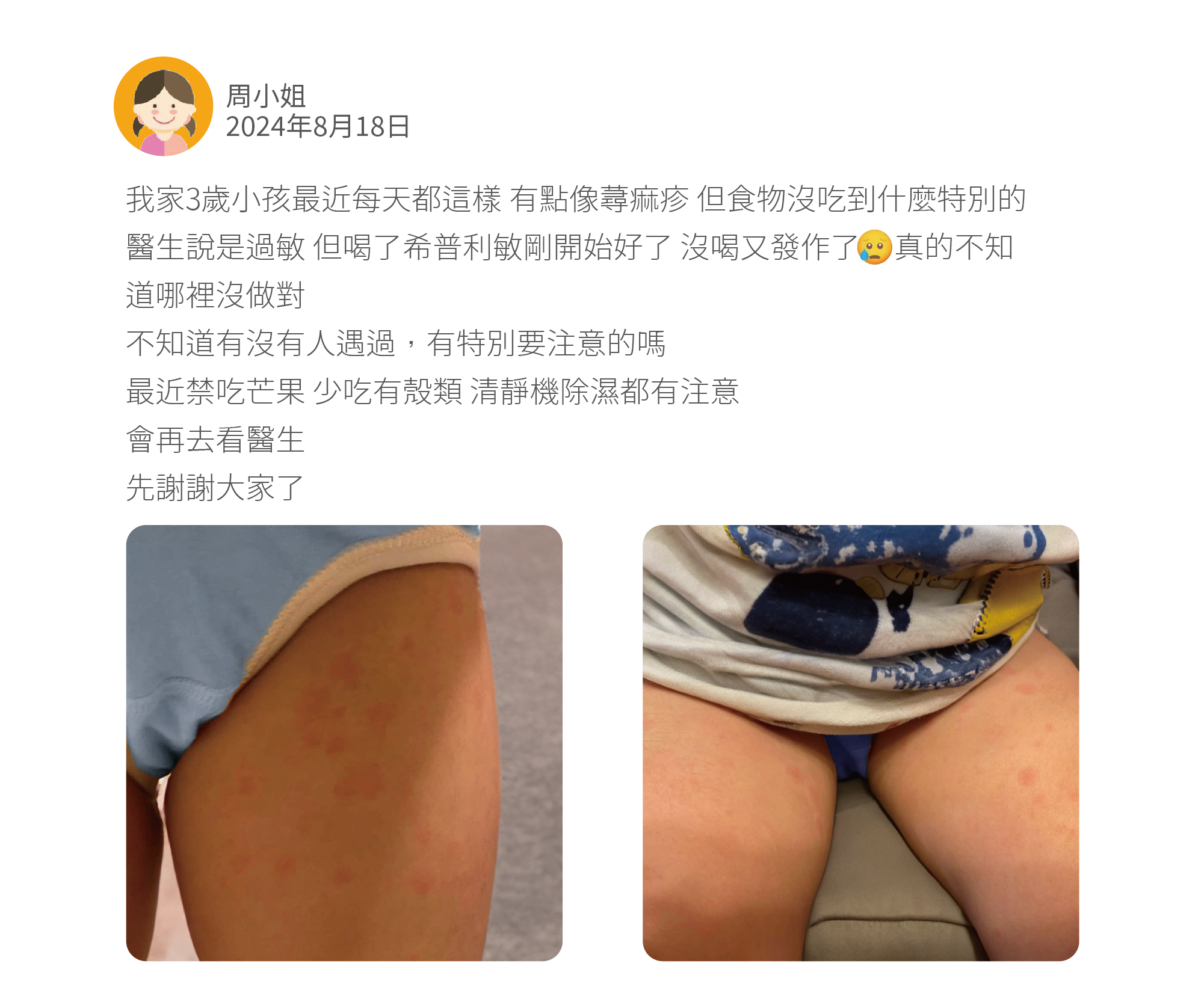 我家3歲小孩最近每天都這樣 有點像蕁痲疹 但食物沒吃到什麼特別的 醫生說是過敏 但喝了希普利敏剛開始好了 沒喝又發作了 真的不知道哪裡沒做對 不知道有沒有人遇過,有特別要注意的嗎 最近禁吃芒果 少吃有殼類 清靜機除濕都有注意 會再去看醫生 先謝謝大家了