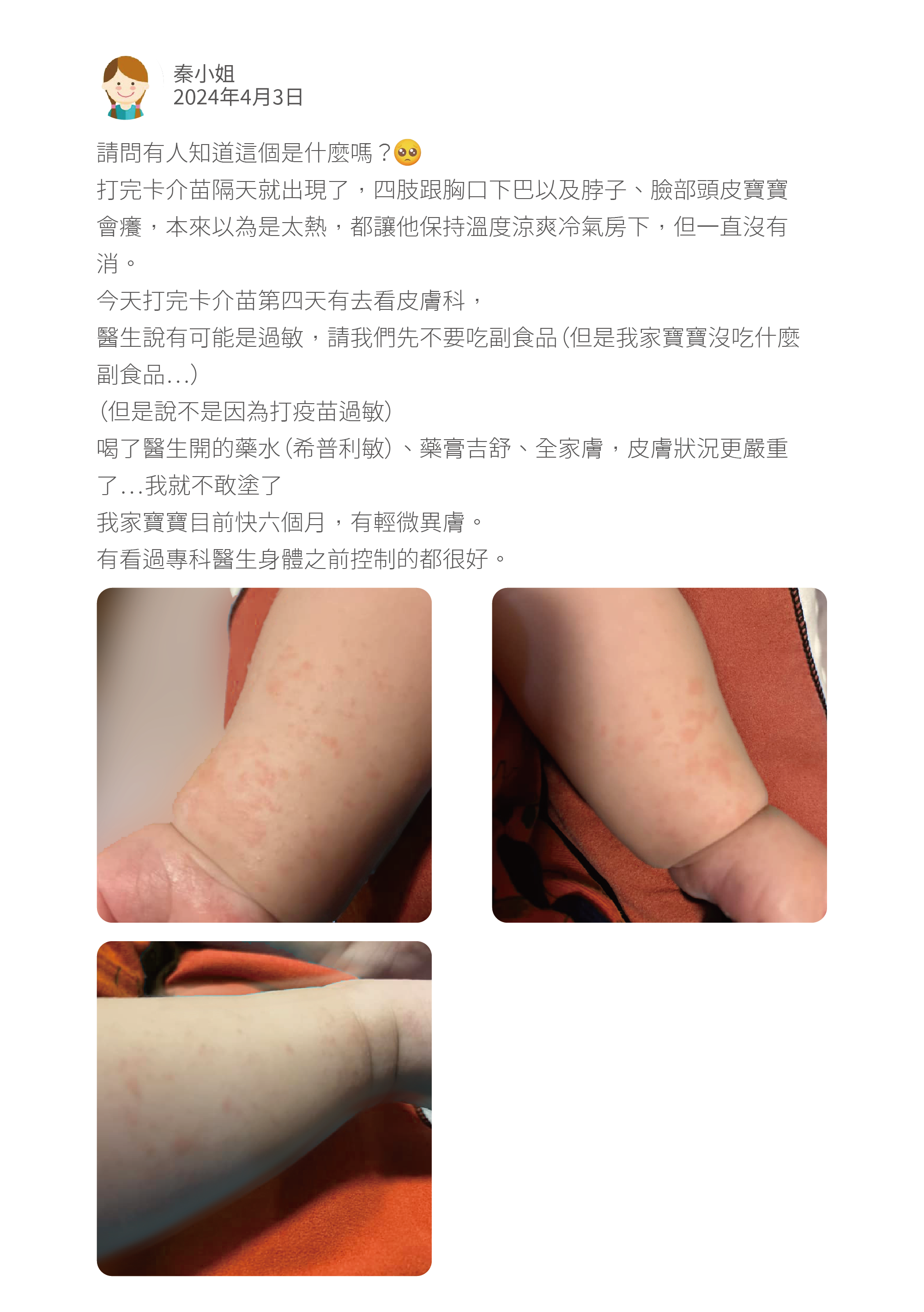 請問有人知道這個是什麼嗎? 打完卡介苗隔天就出現了,四肢跟胸口下巴以及脖子、臉部頭皮寶寶會癢,本來以為是太熱,都讓他保持溫度涼爽冷氣房下,但一直沒有消。 今天打完卡介苗第四天有去看皮膚科, 醫生說有可能是過敏,請我們先不要吃副食品(但是我家寶寶沒吃什麼副食品⋯) (但是說不是因為打疫苗過敏) 喝了醫生開的藥水(希普利敏)、藥膏吉舒、全家膚,皮膚狀況更嚴重了⋯我就不敢塗了 我家寶寶目前快六個月,有輕微異膚。 有看過專科醫生身體之前控制的都很好。