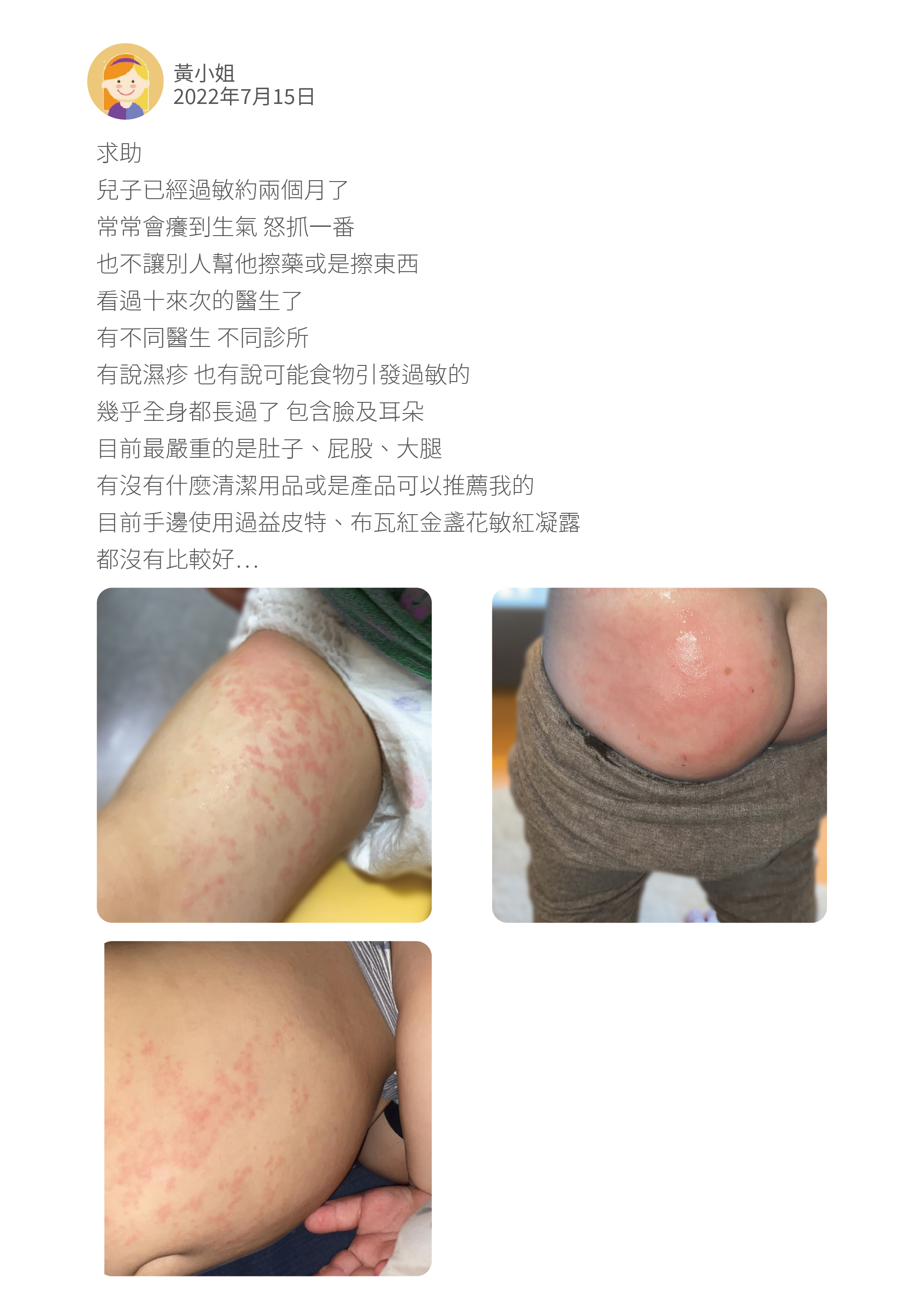 求助 兒子已經過敏約兩個月了 常常會癢到生氣 怒抓一番 也不讓別人幫他擦藥或是擦東西 看過十來次的醫生了 有不同醫生 不同診所 有說濕疹 也有說可能食物引發過敏的 幾乎全身都長過了 包含臉及耳朵 目前最嚴重的是肚子、屁股、大腿 有沒有什麼清潔用品或是產品可以推薦我的 目前手邊使用過益皮特、布瓦紅金盞花敏紅凝露 都沒有比較好⋯