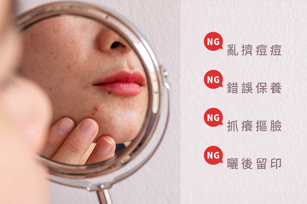 NARUKO牛爾 茶樹痘印美白寶10ml