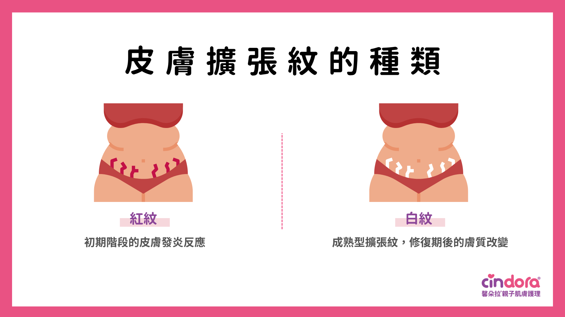 皮膚擴張紋的種類