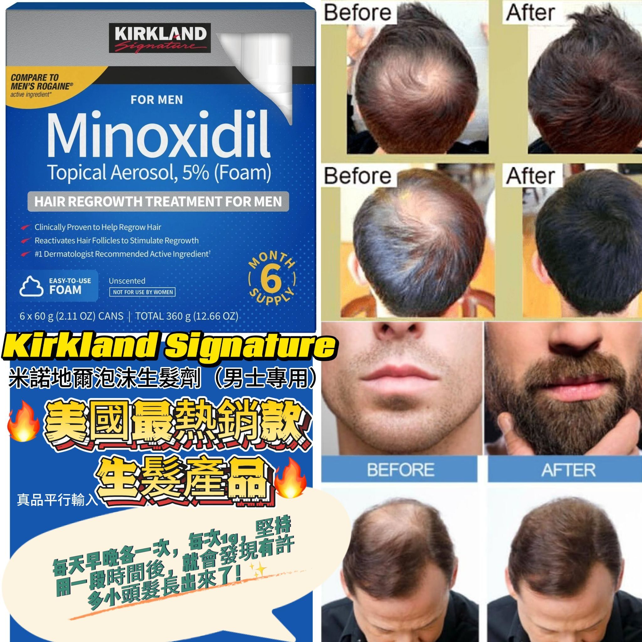 【預購】Kirkland Signature G061004 米諾地爾泡沫生髮劑（男士專用）