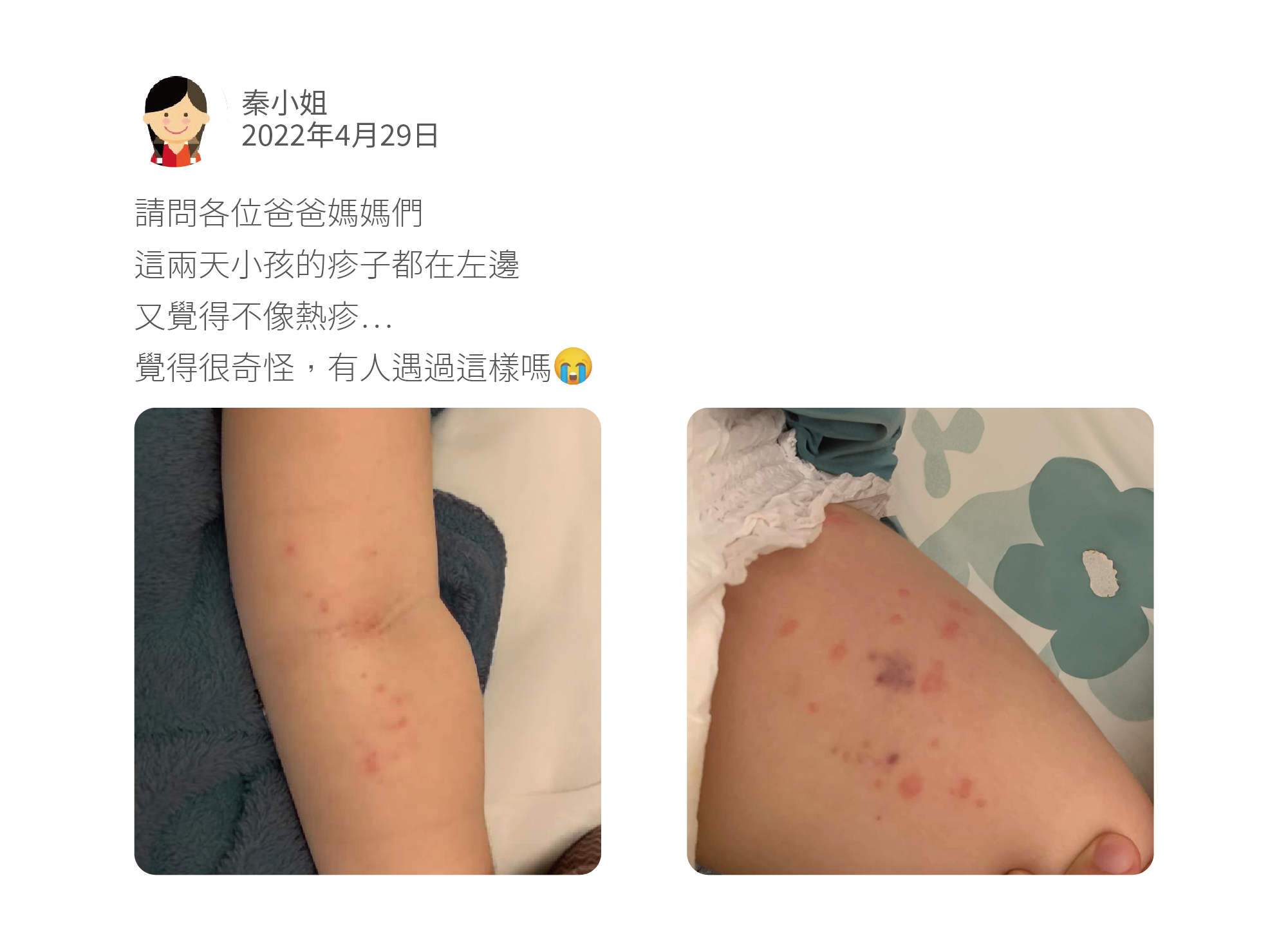 請問各位爸爸媽媽們 這兩天小孩的疹子都在左邊 又覺得不像熱疹… 覺得很奇怪,有人遇過這樣嗎