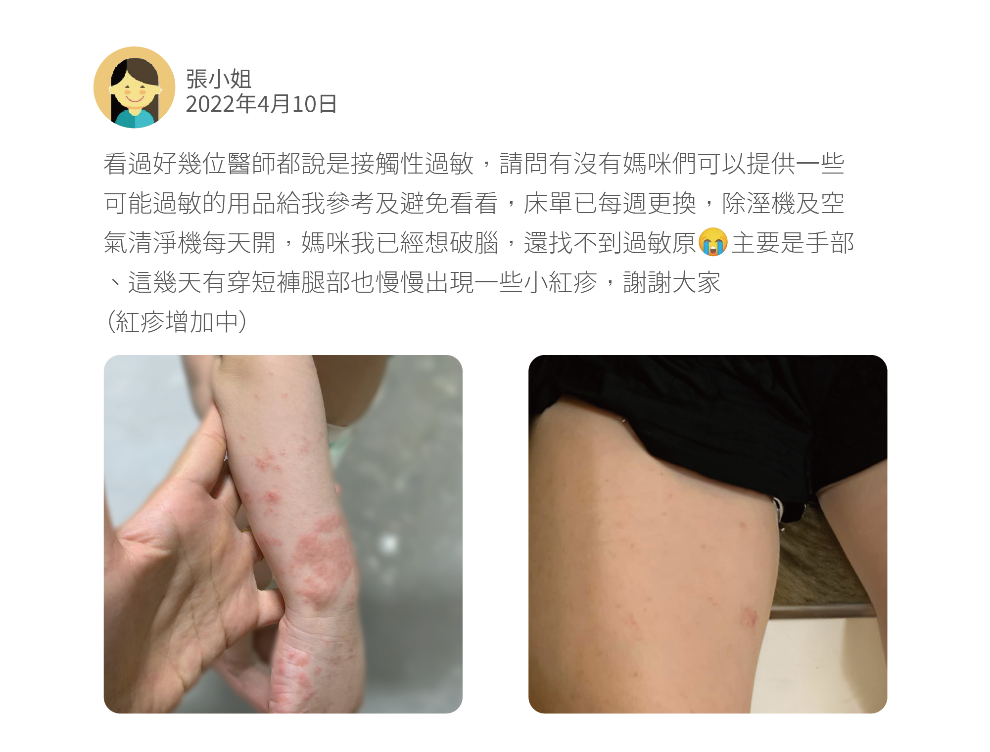 看過好幾位醫師都說是接觸性過敏,請問有沒有媽咪們可以提供一些可能過敏的用品給我參考及避免看看,床單已每週更換,除溼機及空氣清淨機每天開,媽咪我已經想破腦,還找不到過敏原 主要是手部、這幾天有穿短褲腿部也慢慢出現一些小紅疹,謝謝大家 (紅疹增加中)