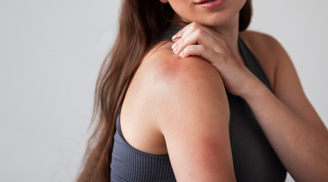 皮膚發炎與曬傷都會導致紅腫、搔癢、脫皮等不適，錯誤護理可能加重發炎，甚至造成色素沉澱！一起來學習正確的護理方法，讓肌膚快速恢復健康。   皮膚紅腫、刺痛、脫皮怎麼辦？