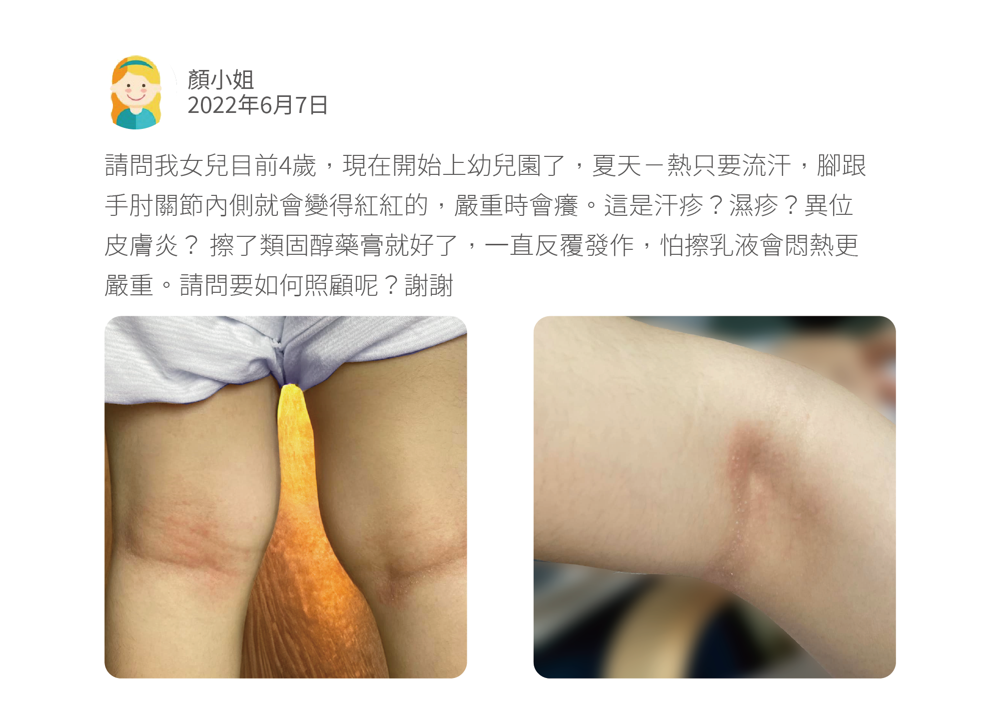 請問我女兒目前4歲，現在開始上幼兒園了，夏天ㄧ熱只要流汗，腳跟手肘關節內側就會變得紅紅的，嚴重時會癢。這是汗疹？濕疹？異位皮膚炎？ 擦了類固醇藥膏就好了，一直反覆發作，怕擦乳液會悶熱更嚴重。請問要如何照顧呢？謝謝