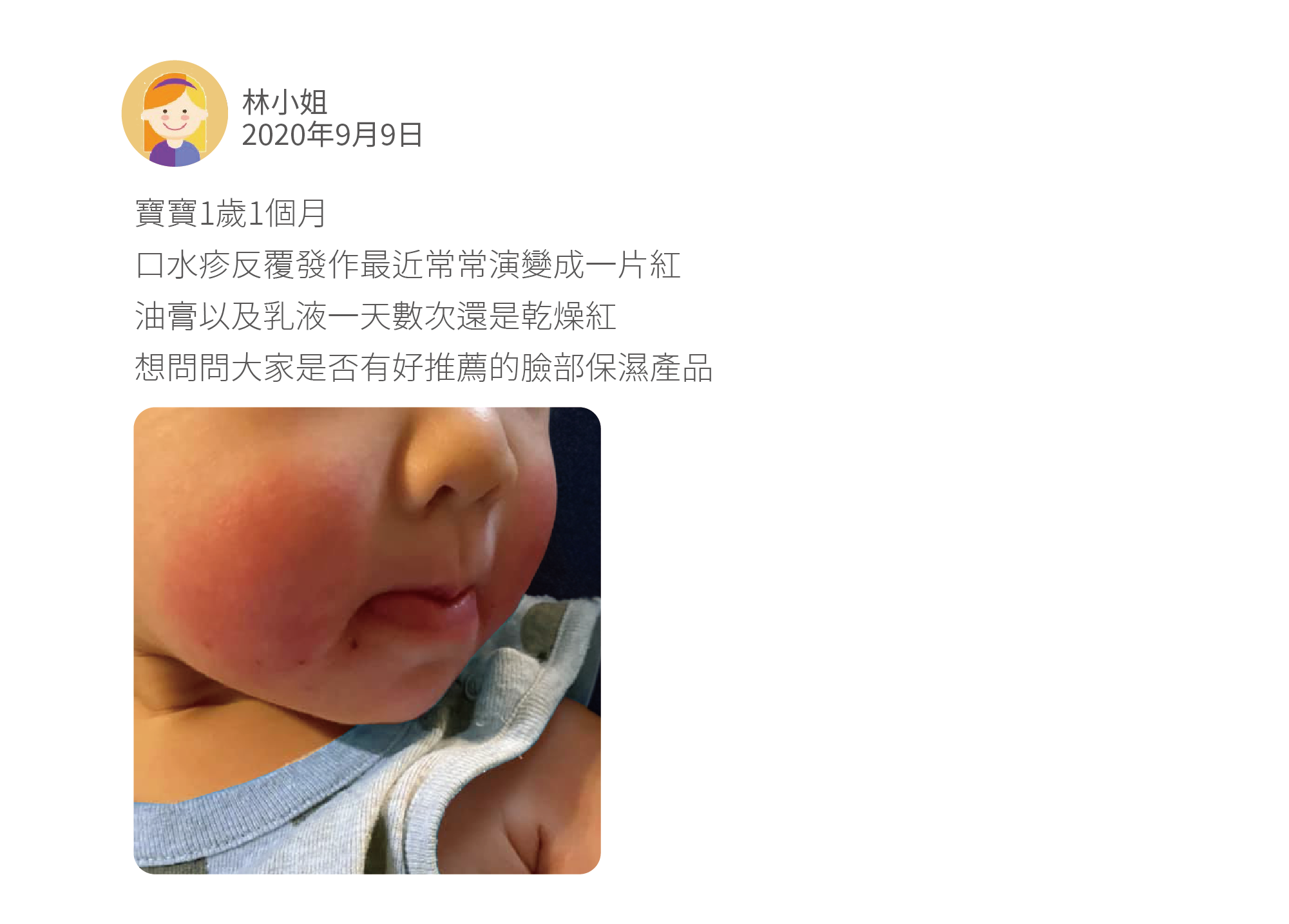 寶寶1歲1個月 口水疹反覆發作最近常常演變成一片紅 油膏以及乳液一天數次還是乾燥紅 想問問大家是否有好推薦的臉部保濕產品