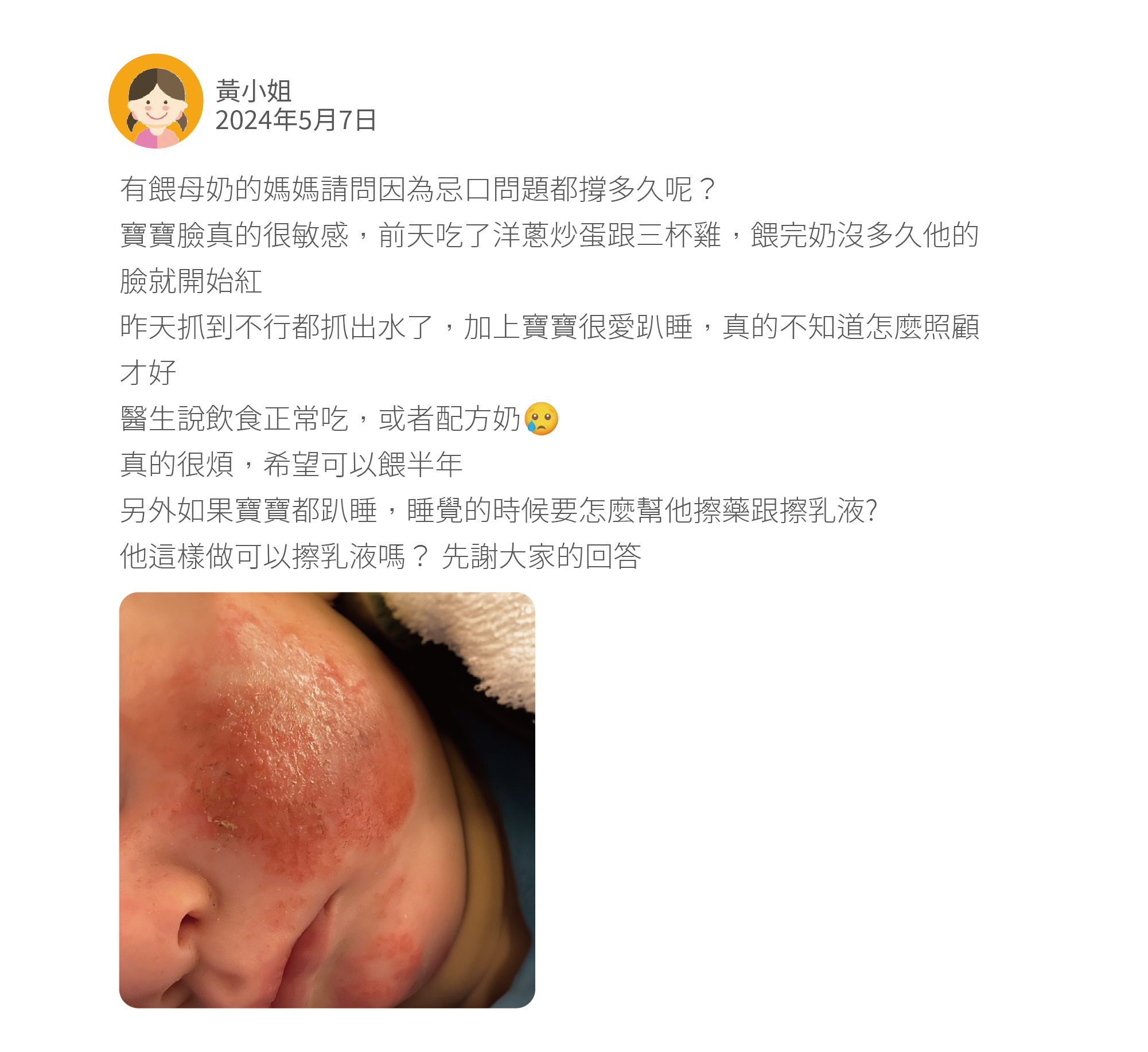 有餵母奶的媽媽請問因為忌口問題都撐多久呢？ 寶寶臉真的很敏感，前天吃了洋蔥炒蛋跟三杯雞，餵完奶沒多久他的臉就開始紅 昨天抓到不行都抓出水了，加上寶寶很愛趴睡，真的不知道怎麼照顧才好 醫生說飲食正常吃，或者配方奶 真的很煩，希望可以餵半年 另外如果寶寶都趴睡，睡覺的時候要怎麼幫他擦藥跟擦乳液? 他這樣做可以擦乳液嗎？ 先謝大家的回答