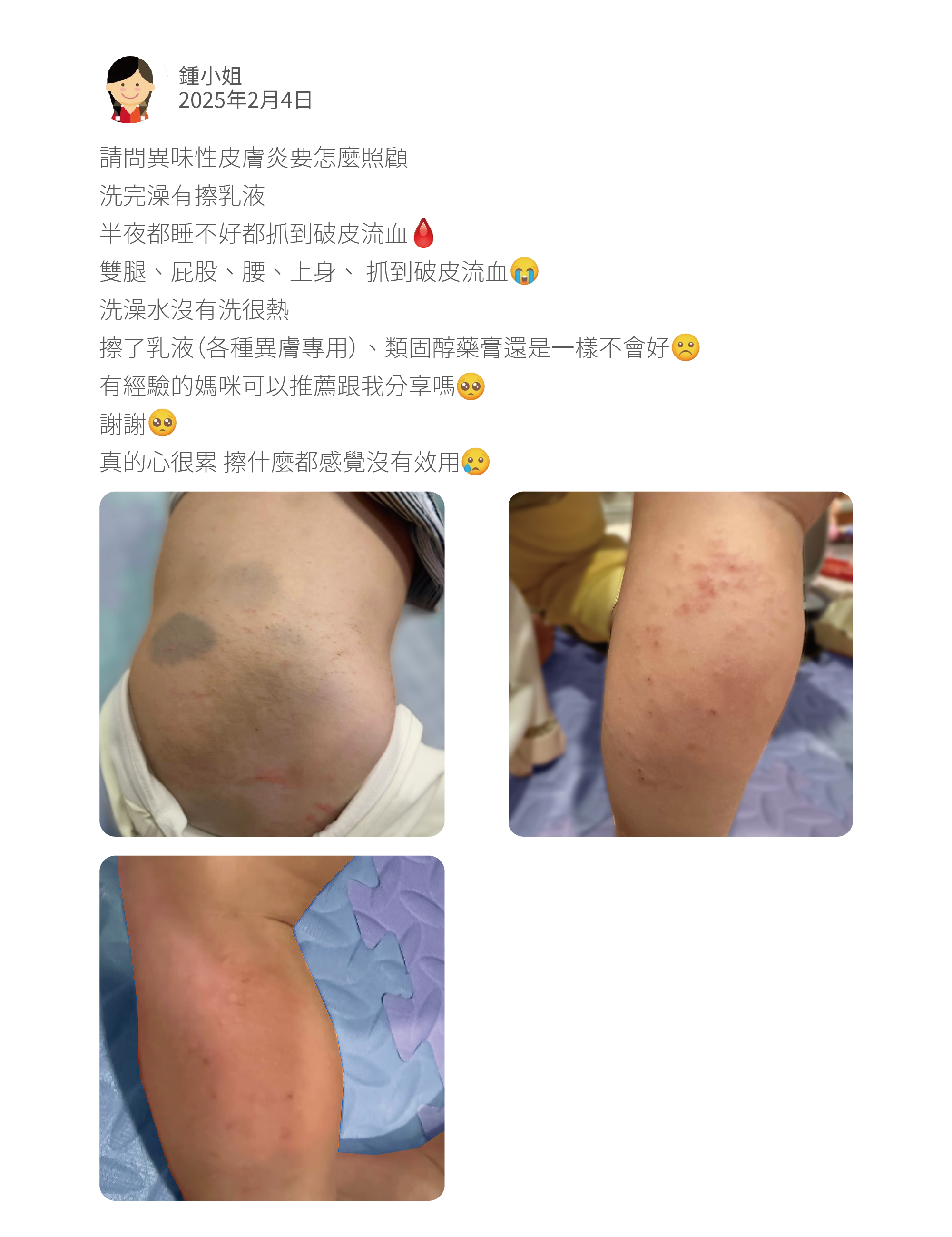 請問異味性皮膚炎要怎麼照顧 洗完澡有擦乳液 半夜都睡不好都抓到破皮流血 雙腿、屁股、腰、上身、 抓到破皮流血 洗澡水沒有洗很熱 擦了乳液（各種異膚專用）、類固醇藥膏還是一樣不會好 有經驗的媽咪可以推薦跟我分享嗎 謝謝 真的心很累 擦什麼都感覺沒有效用