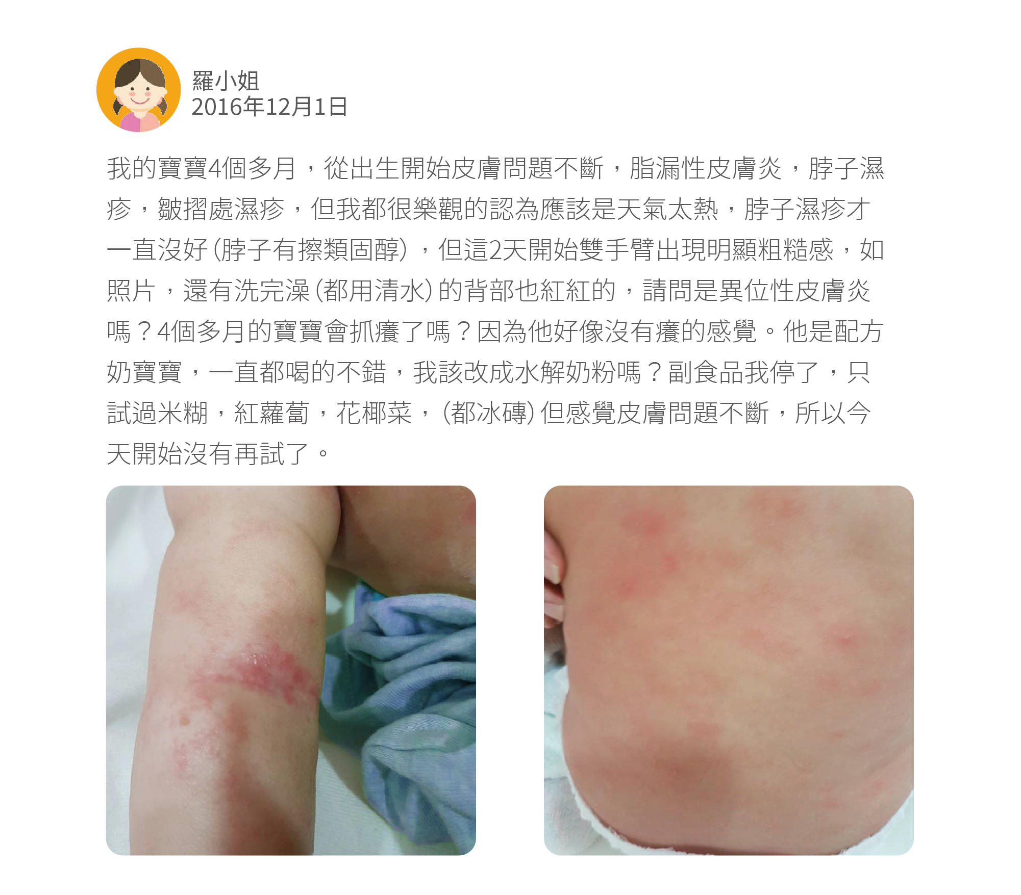 我的寶寶4個多月，從出生開始皮膚問題不斷，脂漏性皮膚炎，脖子濕疹，皺摺處濕疹，但我都很樂觀的認為應該是天氣太熱，脖子濕疹才一直沒好（脖子有擦類固醇），但這2天開始雙手臂出現明顯粗糙感，如照片，還有洗完澡（都用清水）的背部也紅紅的，請問是異位性皮膚炎嗎？4個多月的寶寶會抓癢了嗎？因為他好像沒有癢的感覺。他是配方奶寶寶，一直都喝的不錯，我該改成水解奶粉嗎？副食品我停了，只試過米糊，紅蘿蔔，花椰菜，（都冰磚）但感覺皮膚問題不斷，所以今天開始沒有再試了。