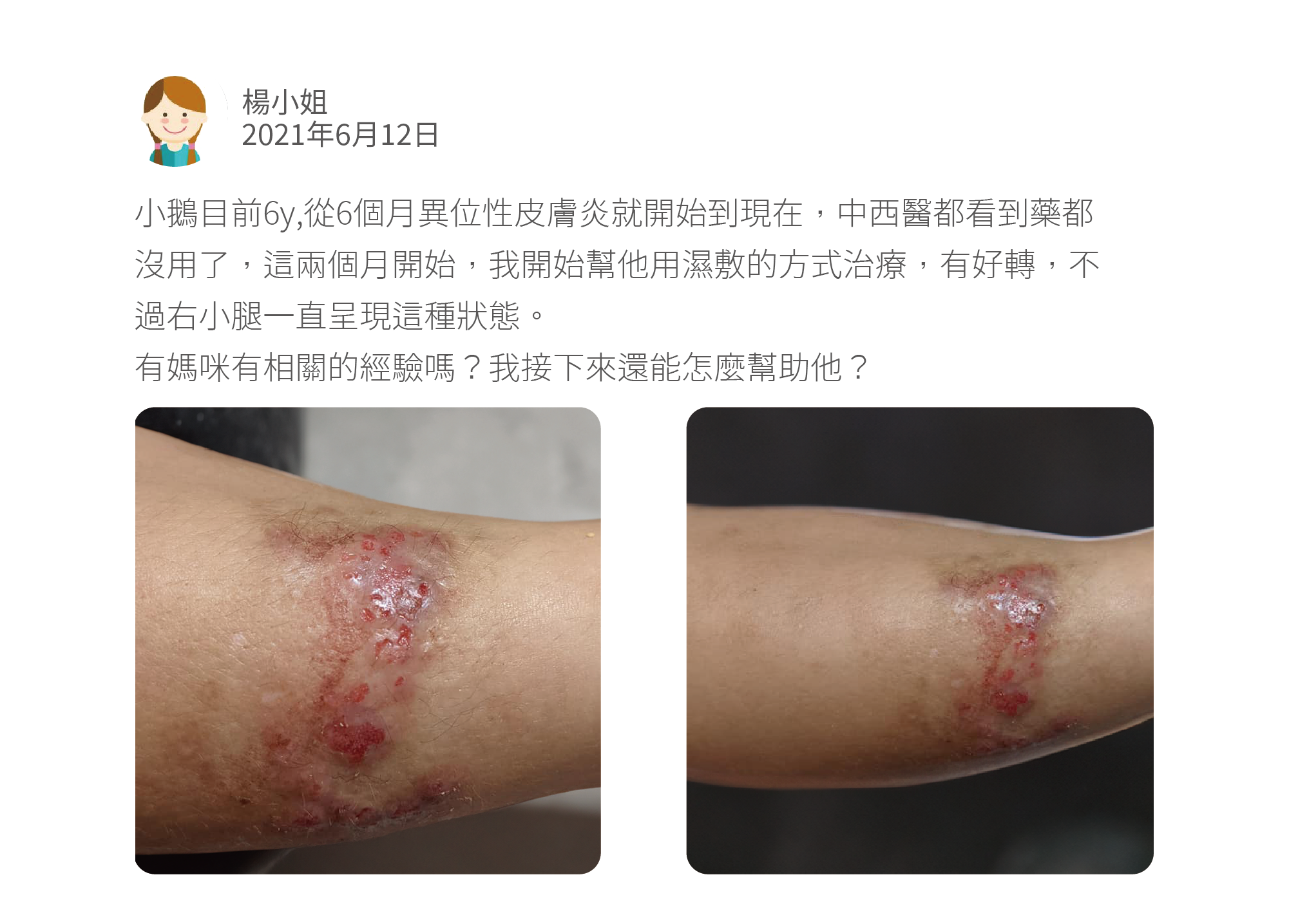 小鵝目前6y,從6個月異位性皮膚炎就開始到現在，中西醫都看到藥都沒用了，這兩個月開始，我開始幫他用濕敷的方式治療，有好轉，不過右小腿一直呈現這種狀態。 有媽咪有相關的經驗嗎？我接下來還能怎麼幫助他？