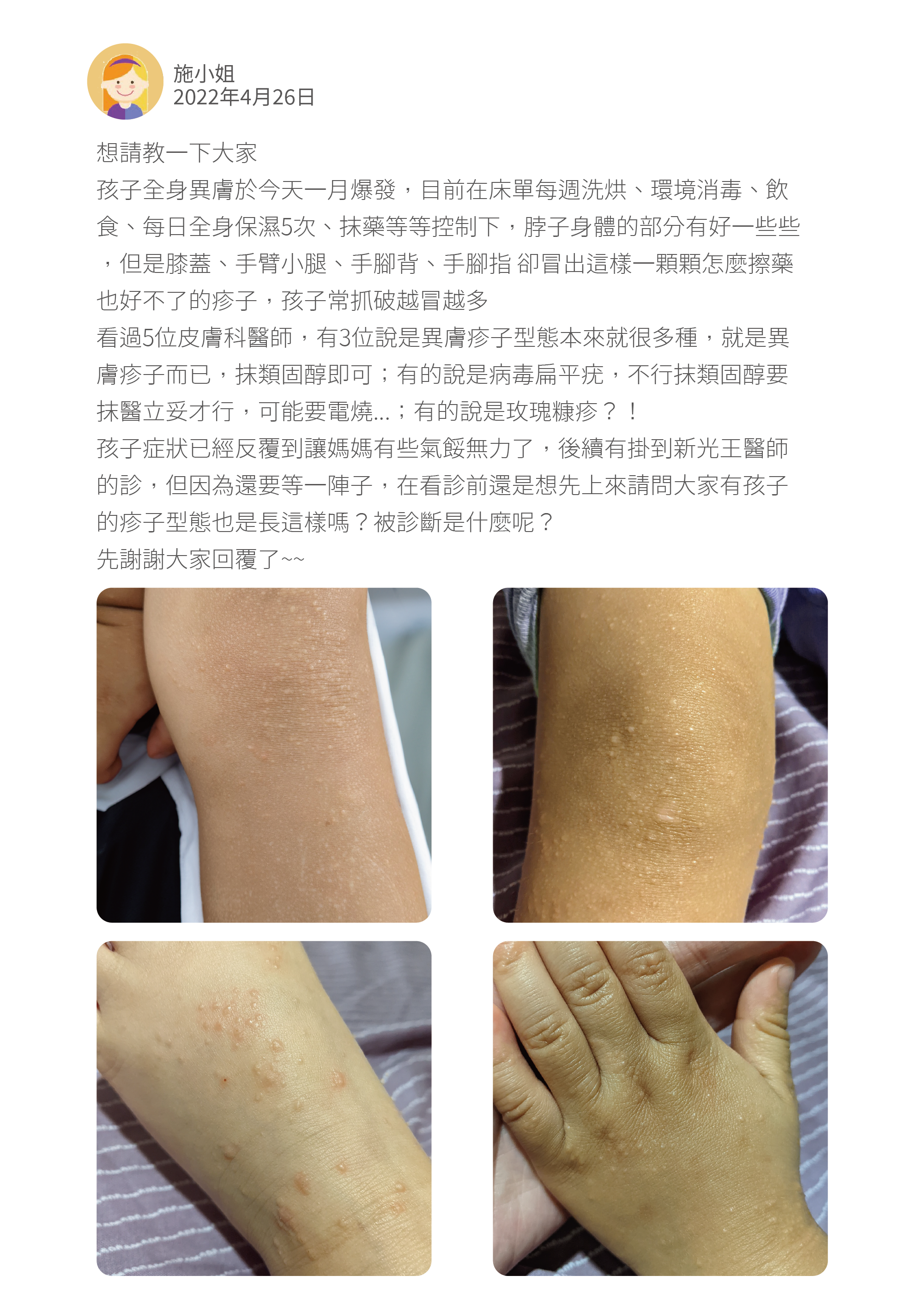 想請教一下大家 孩子全身異膚於今天一月爆發，目前在床單每週洗烘、環境消毒、飲食、每日全身保濕5次、抹藥等等控制下，脖子身體的部分有好一些些，但是膝蓋、手臂小腿、手腳背、手腳指 卻冒出這樣一顆顆怎麼擦藥也好不了的疹子，孩子常抓破越冒越多 看過5位皮膚科醫師，有3位說是異膚疹子型態本來就很多種，就是異膚疹子而已，抹類固醇即可；有的說是病毒扁平疣，不行抹類固醇要抹醫立妥才行，可能要電燒...；有的說是玫瑰糠疹？！ 孩子症狀已經反覆到讓媽媽有些氣餒無力了，後續有掛到新光王醫師的診，但因為還要等一陣子，在看診前還是想先上來請問大家有孩子的疹子型態也是長這樣嗎？被診斷是什麼呢？ 先謝謝大家回覆了~~