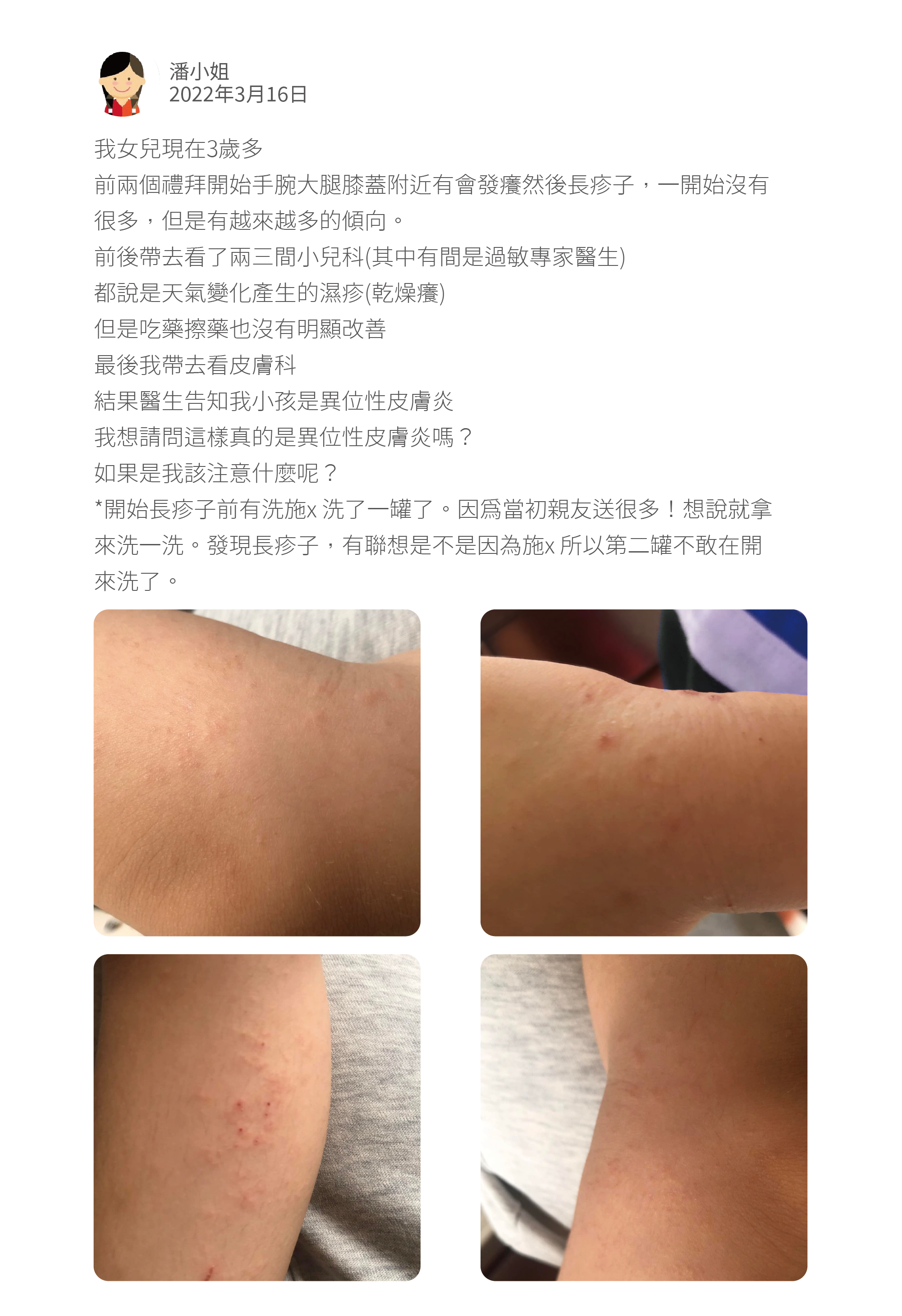 我女兒現在3歲多 前兩個禮拜開始手腕大腿膝蓋附近有會發癢然後長疹子，一開始沒有很多，但是有越來越多的傾向。 前後帶去看了兩三間小兒科(其中有間是過敏專家醫生) 都說是天氣變化產生的濕疹(乾燥癢) 但是吃藥擦藥也沒有明顯改善 最後我帶去看皮膚科 結果醫生告知我小孩是異位性皮膚炎 我想請問這樣真的是異位性皮膚炎嗎？ 如果是我該注意什麼呢？ *開始長疹子前有洗施x 洗了一罐了。因爲當初親友送很多！想說就拿來洗一洗。發現長疹子，有聯想是不是因為施x 所以第二罐不敢在開來洗了。